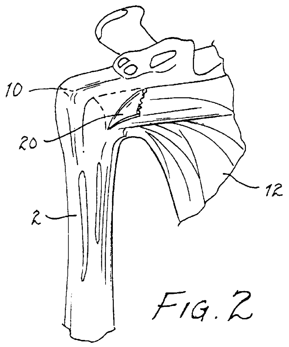 Method for surgical repair with hook-and-loop fastener