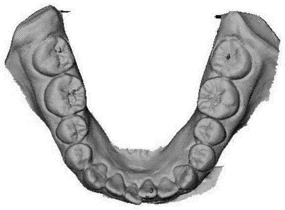 Dentition model generation method based on oral cavity scanning data and CBCT (Cone Beam Computed Tomography) data