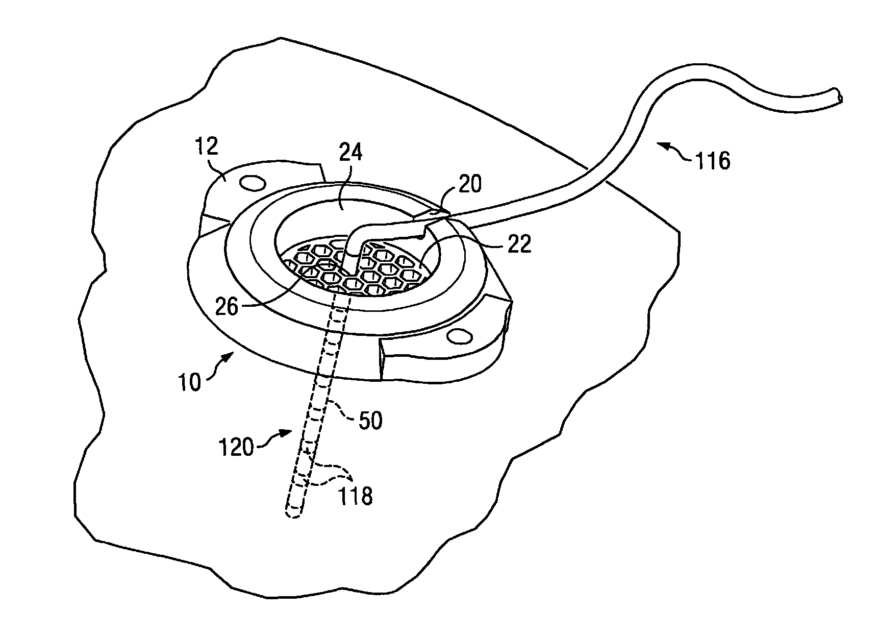 Electrical stimulation system and associated apparatus for securing an electrical stimulation lead in position in a person's brain