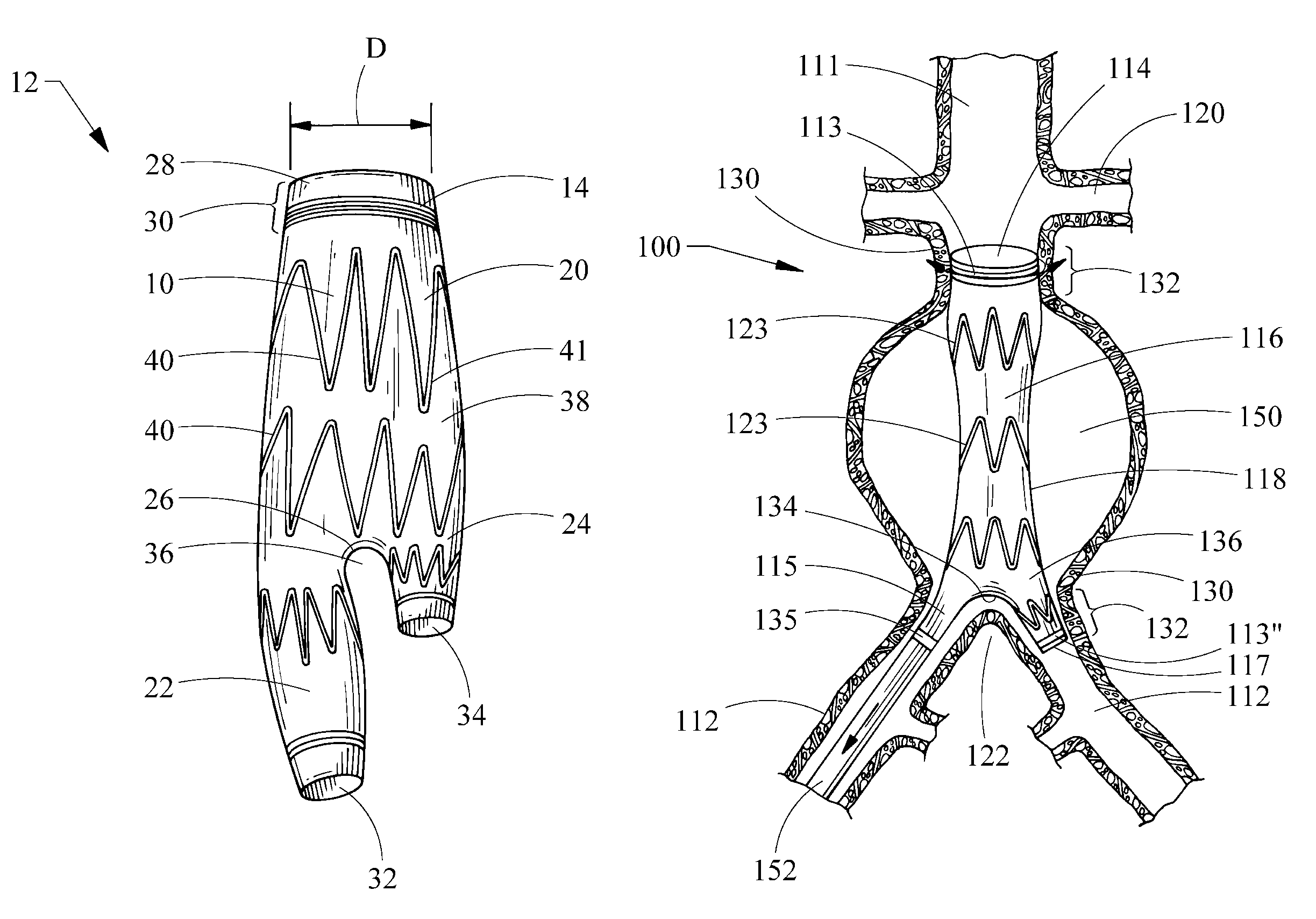 Endoluminal device including a mechanism for proximal or distal fixation, and sealing and methods of use thereof