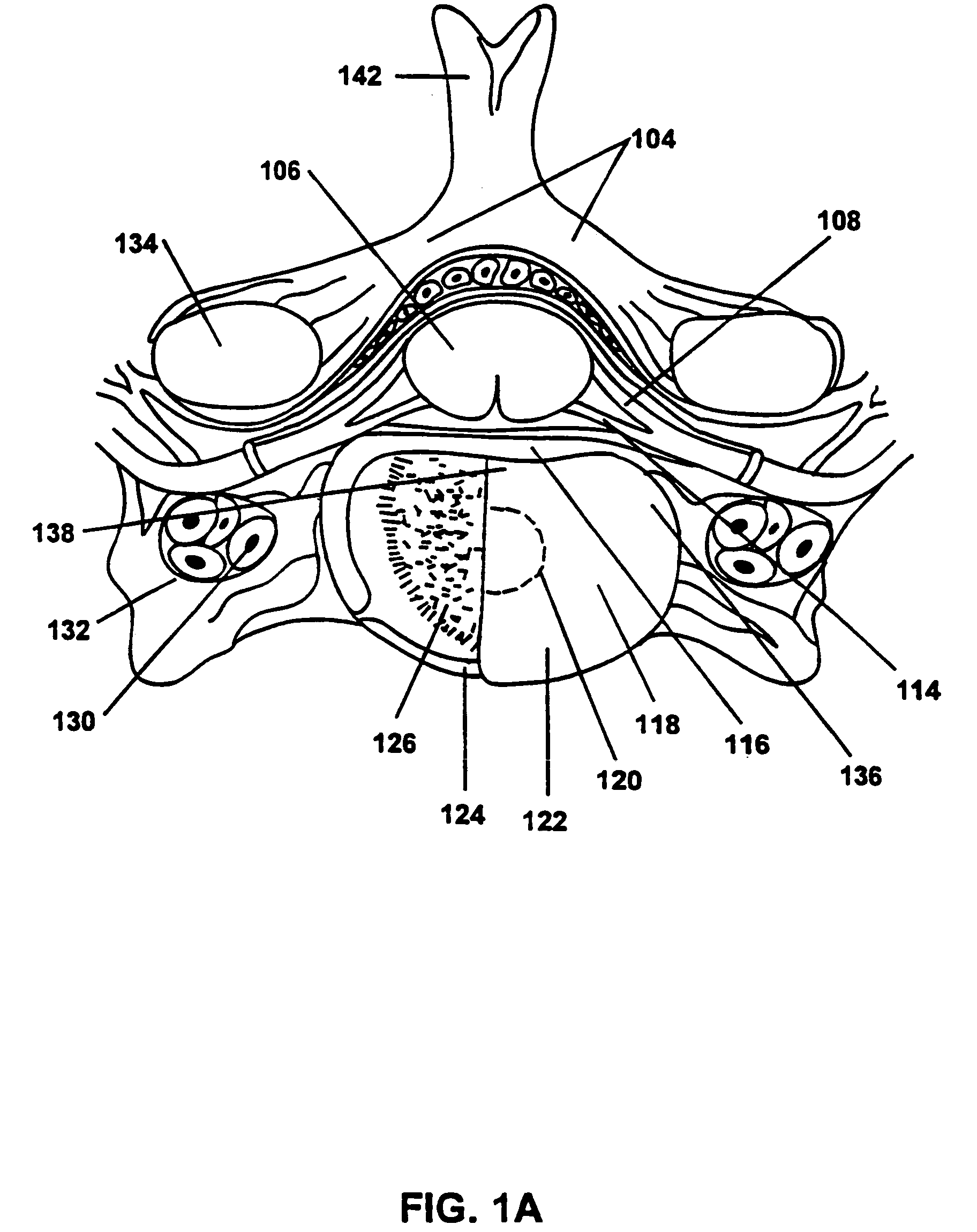 Catheter for delivery of energy to a surgical site