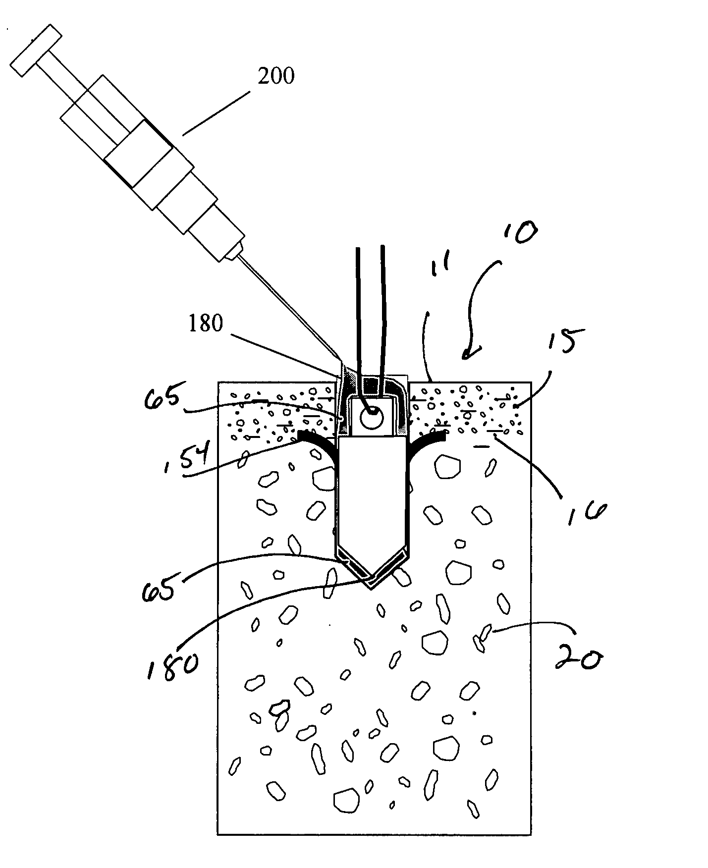 Suture anchor and void filler combination
