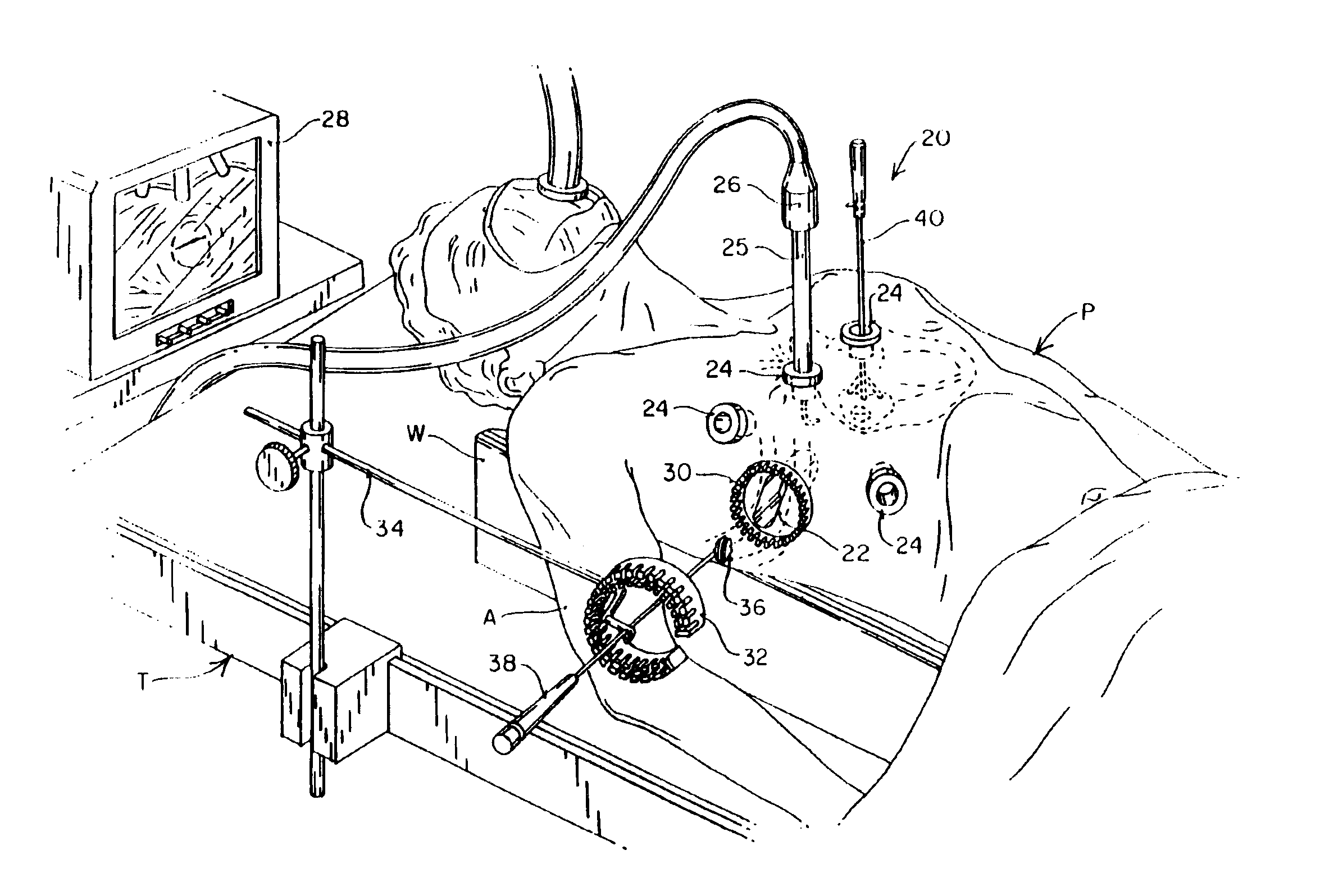 Devices and methods for intracardiac procedures