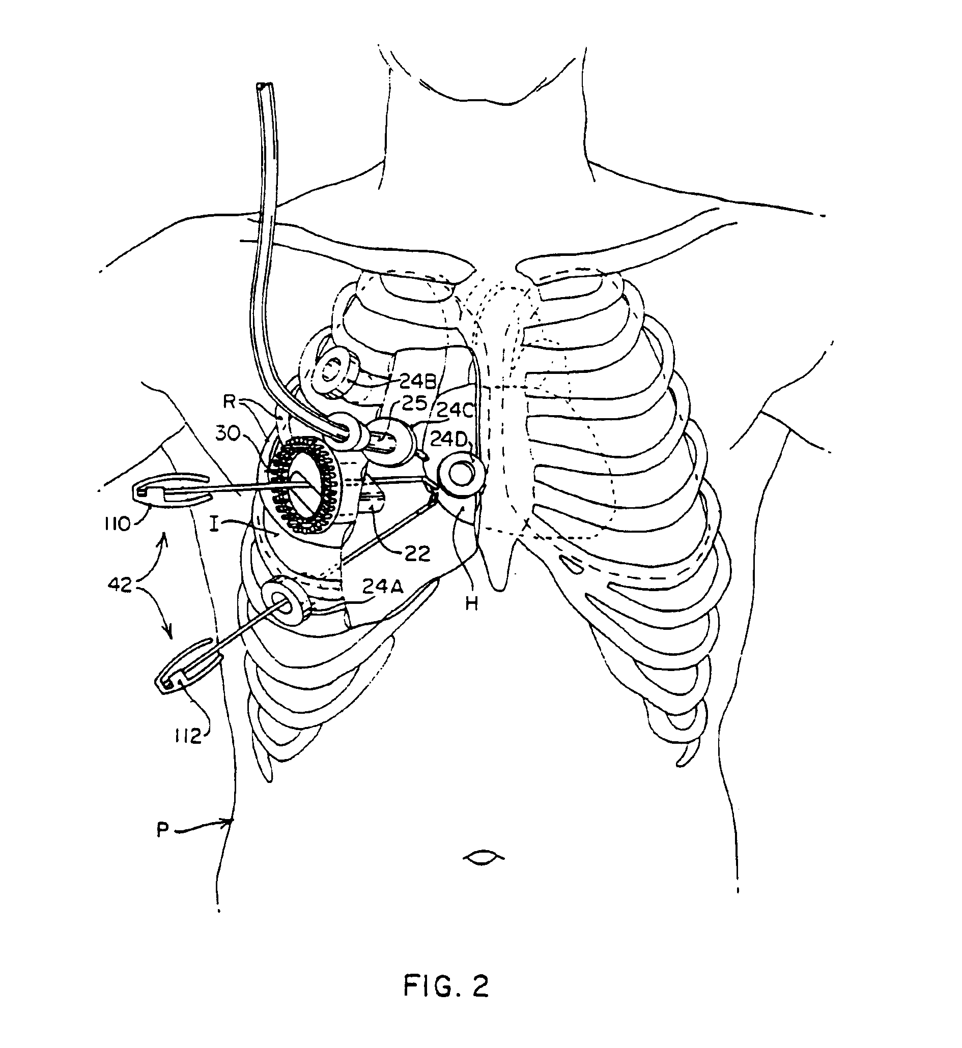 Devices and methods for intracardiac procedures
