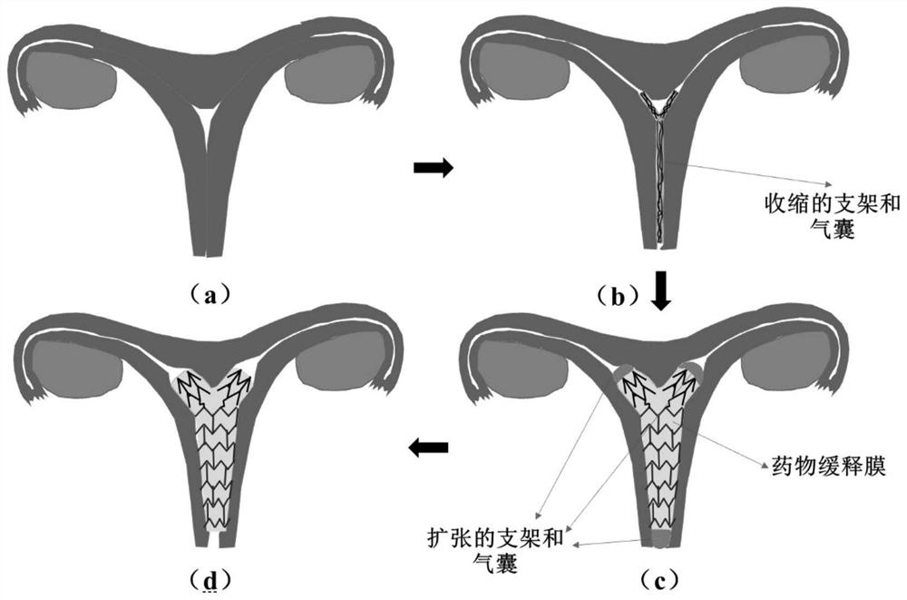 Degradable metal uterine cavity stent, release system and use method