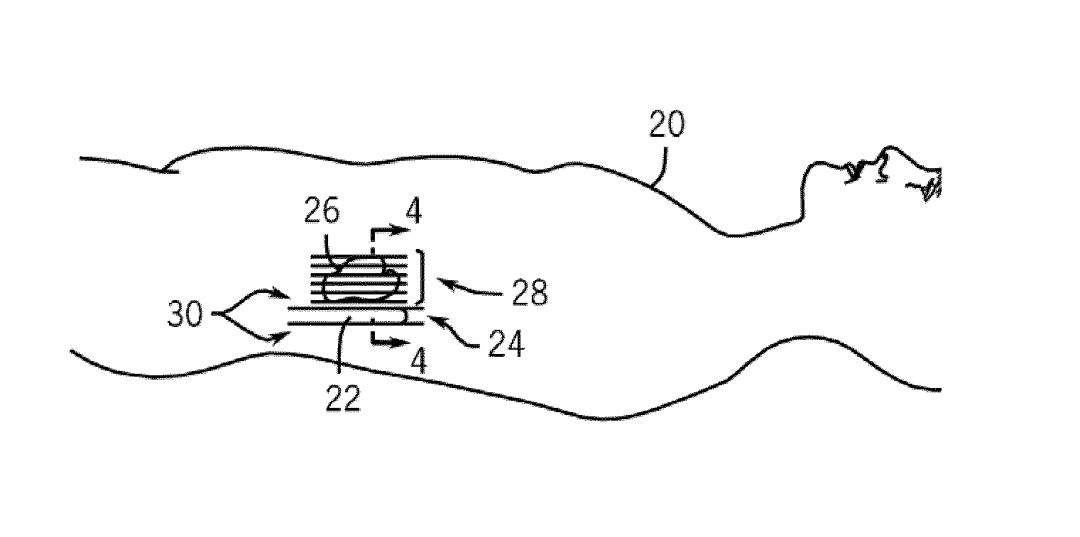 System and method for intracorporeal elastography