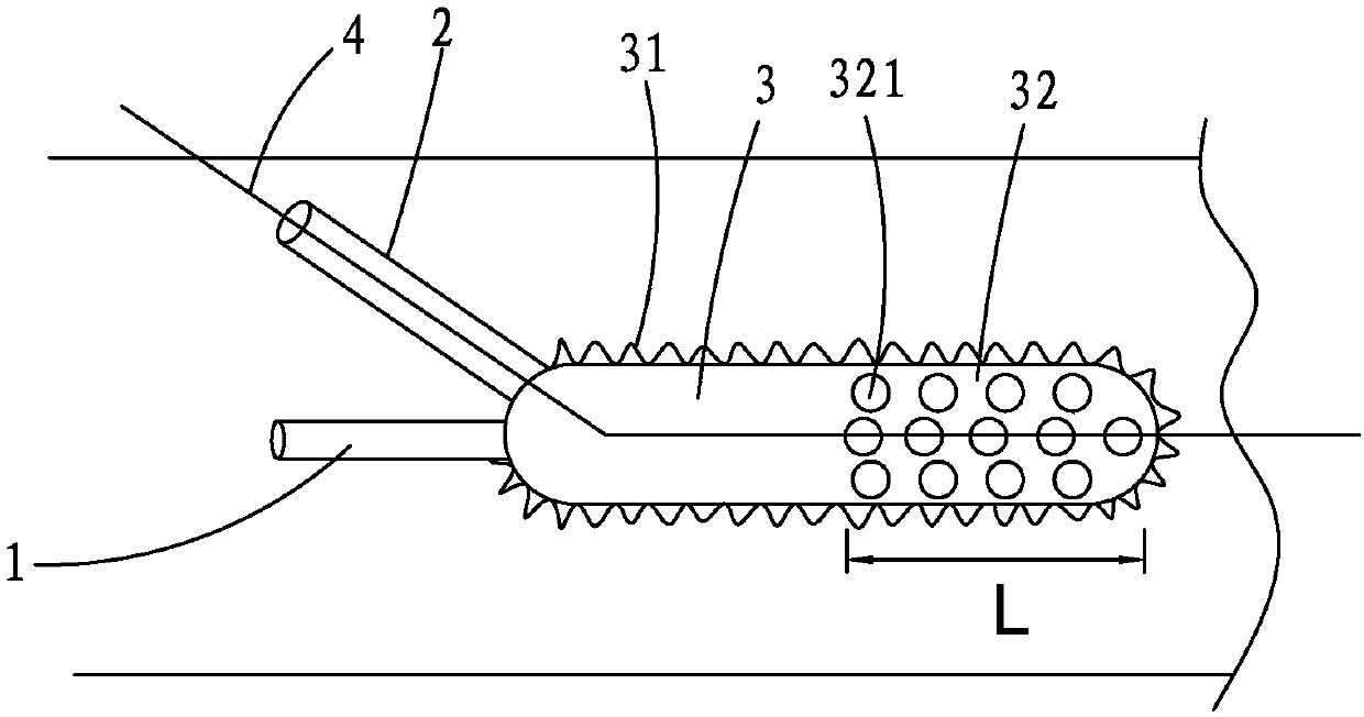 Compound type human great artery intraoperative stent system