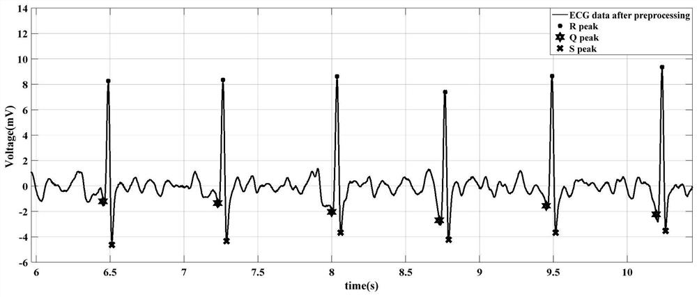 A real-time qrs wave detection method of electrocardiographic signal