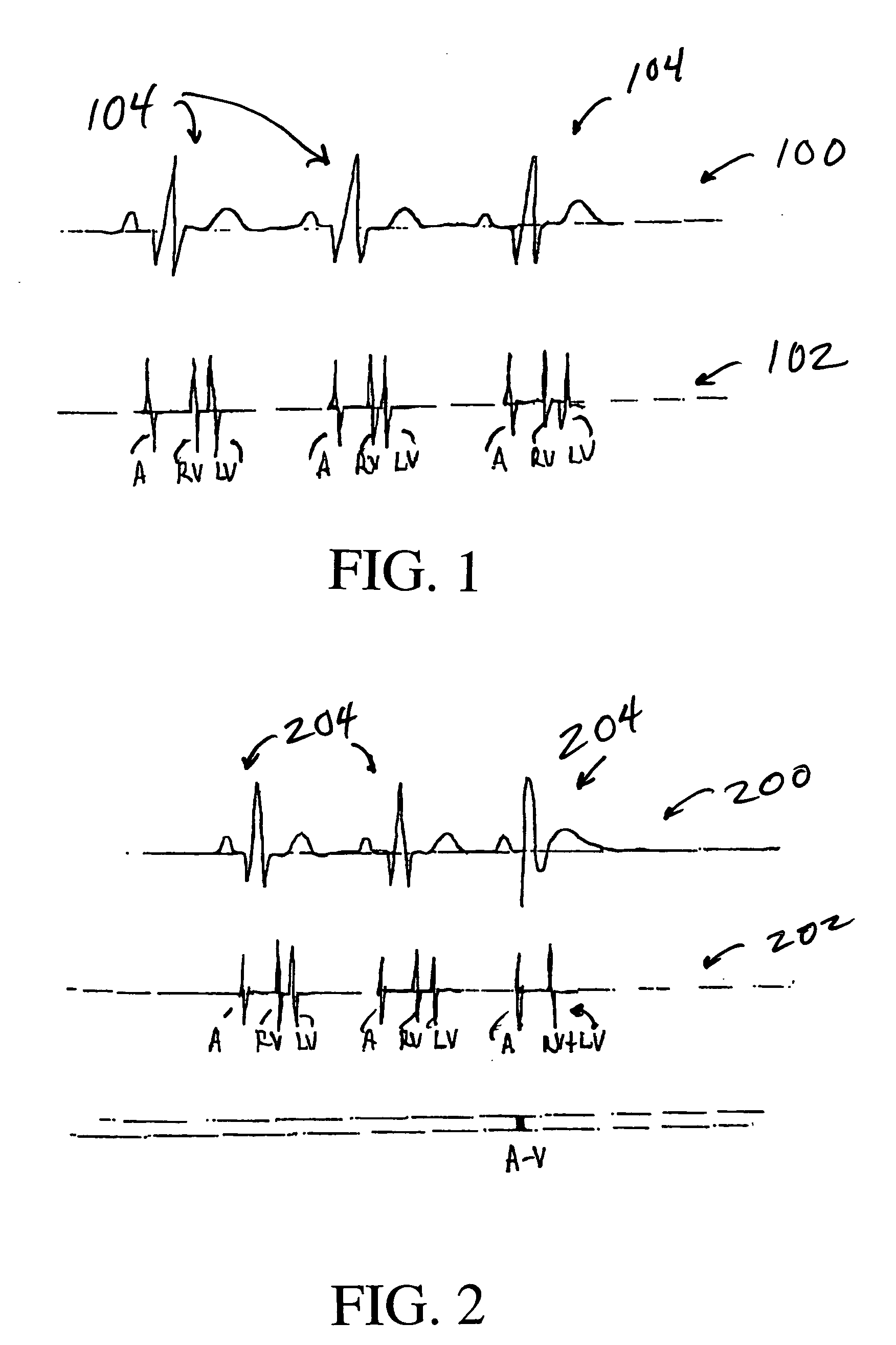 Mechanical sensing system for cardiac pacing and/or for cardiac resynchronization therapy