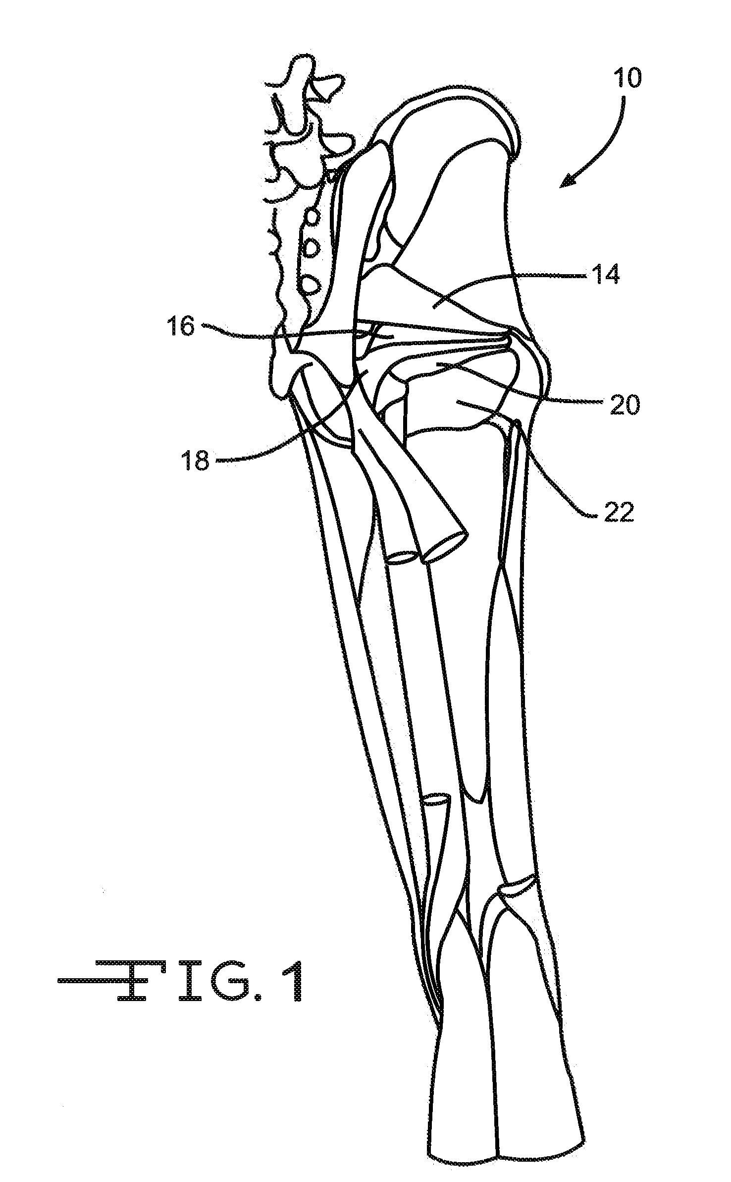 Retractor Tool For Minimally Invasive Hip Replacement Surgery