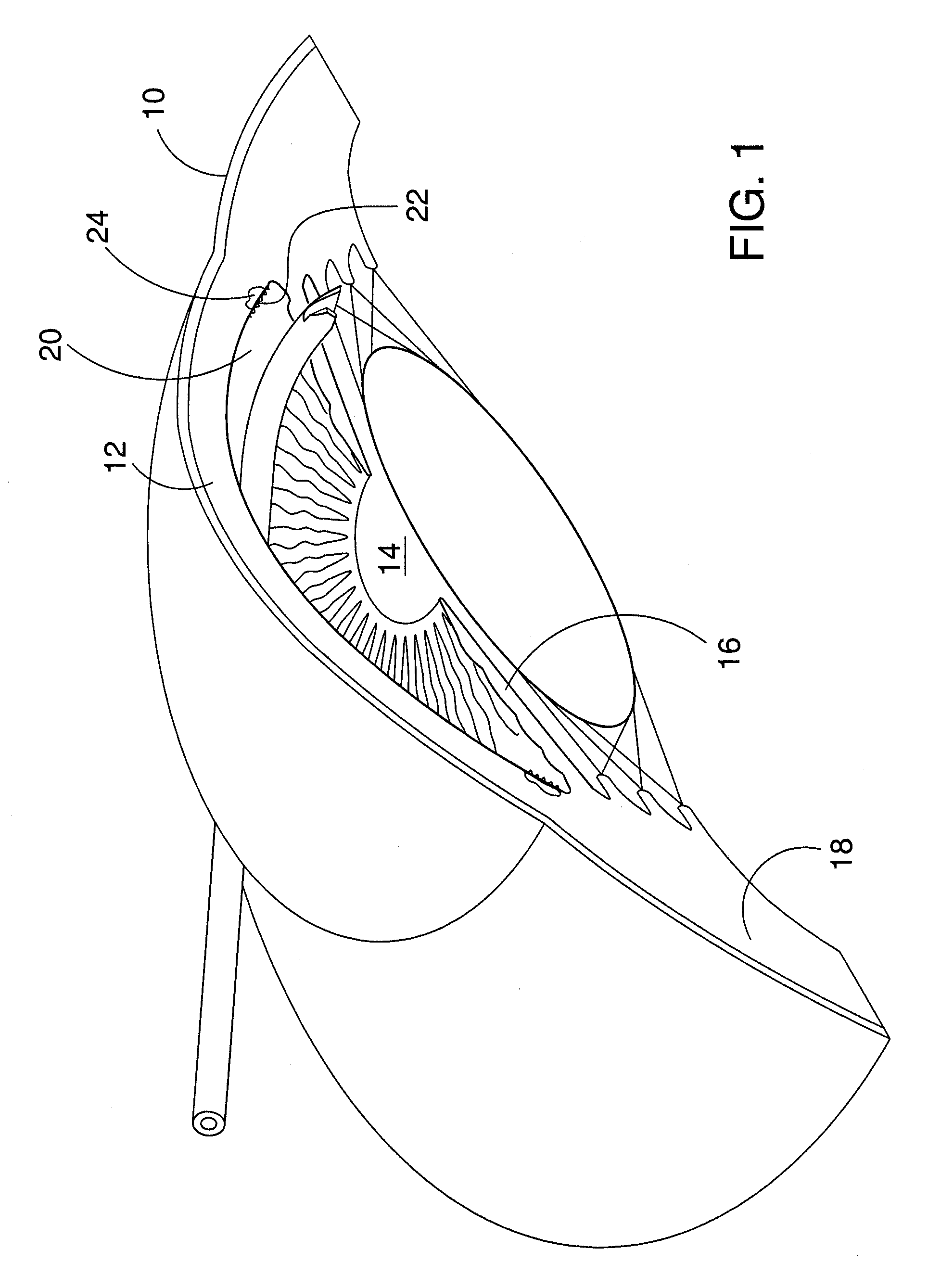 Ocular implant delivery system and method