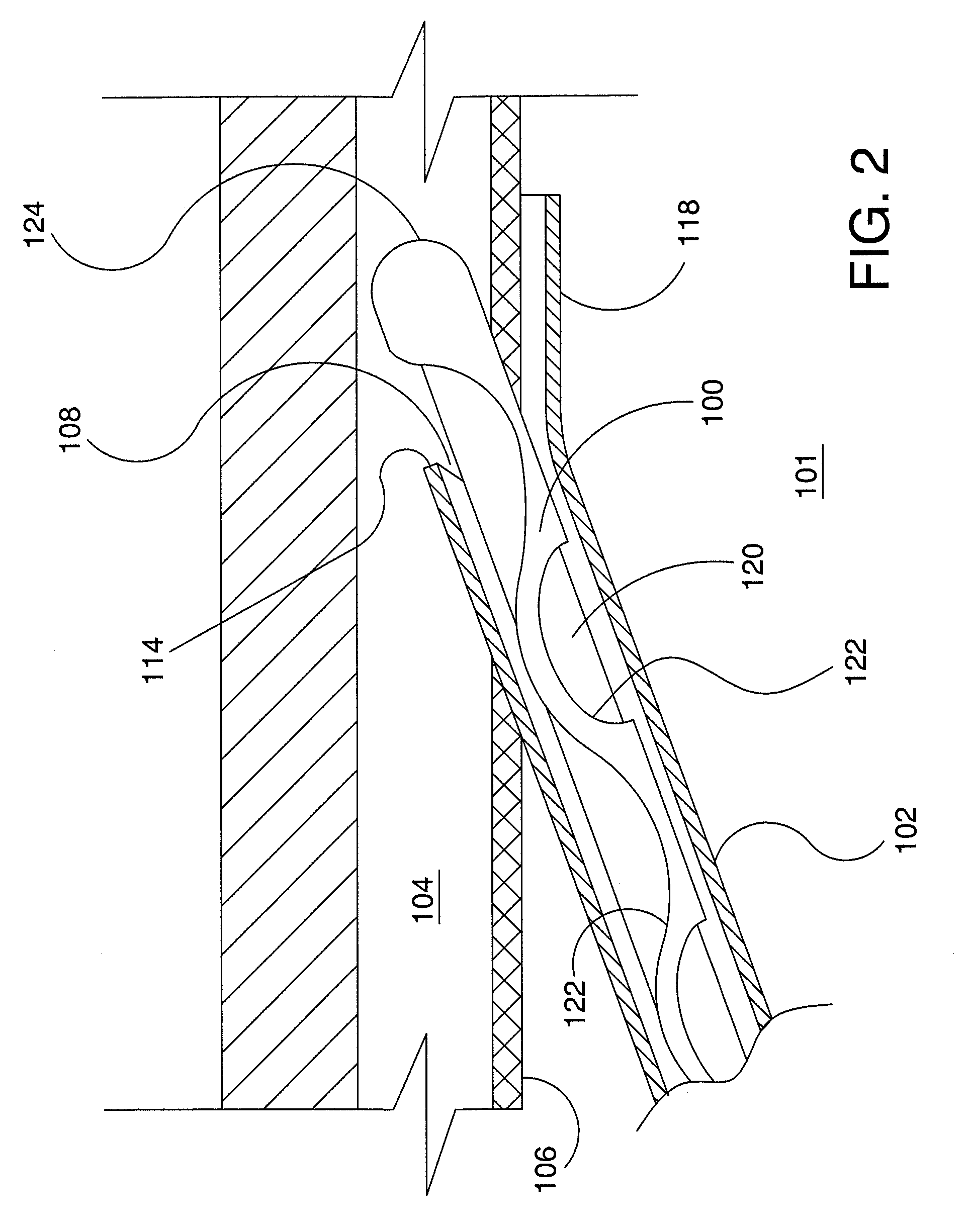 Ocular implant delivery system and method