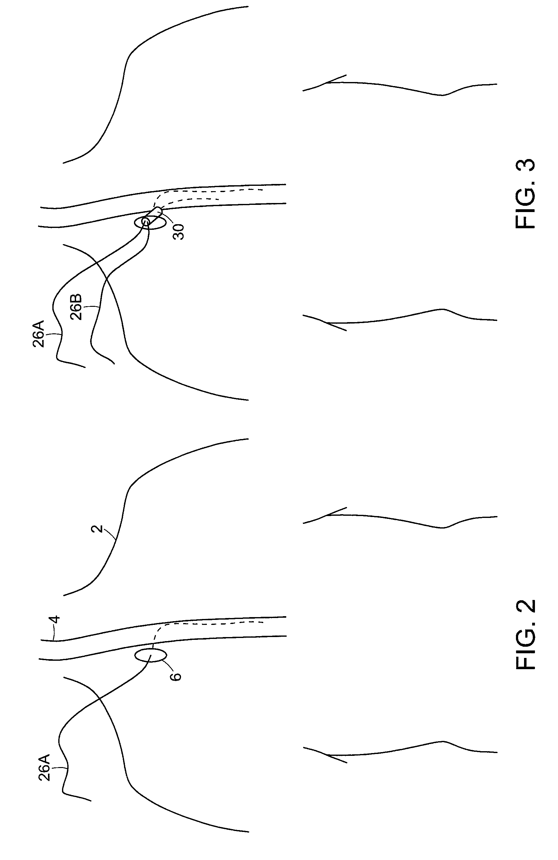 Methods and apparatus for inserting multi-lumen split-tip catheters into a blood vessel