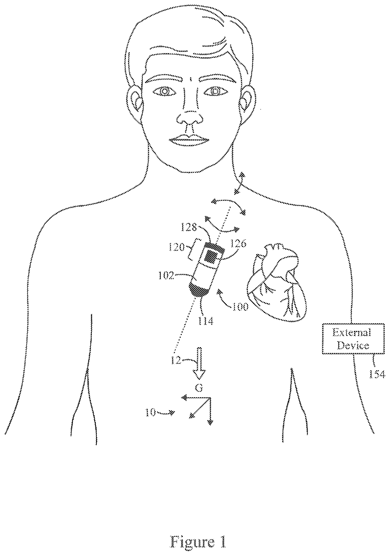 Implantable medical device utilizing posture and heart sounds and method of using same