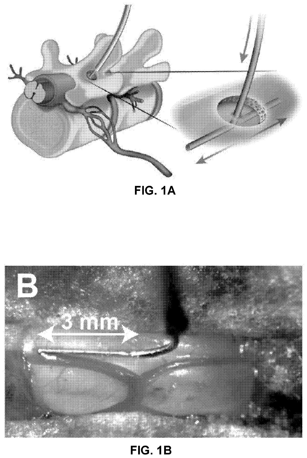 Method and composition for treating neuropathic pain