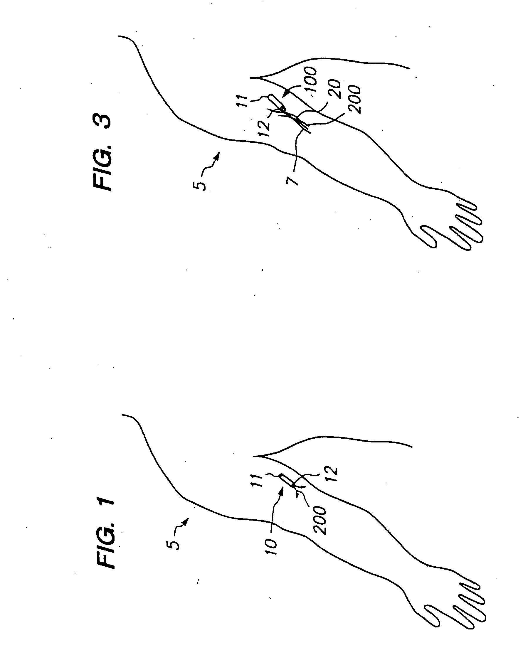 Devices and methods for pain management