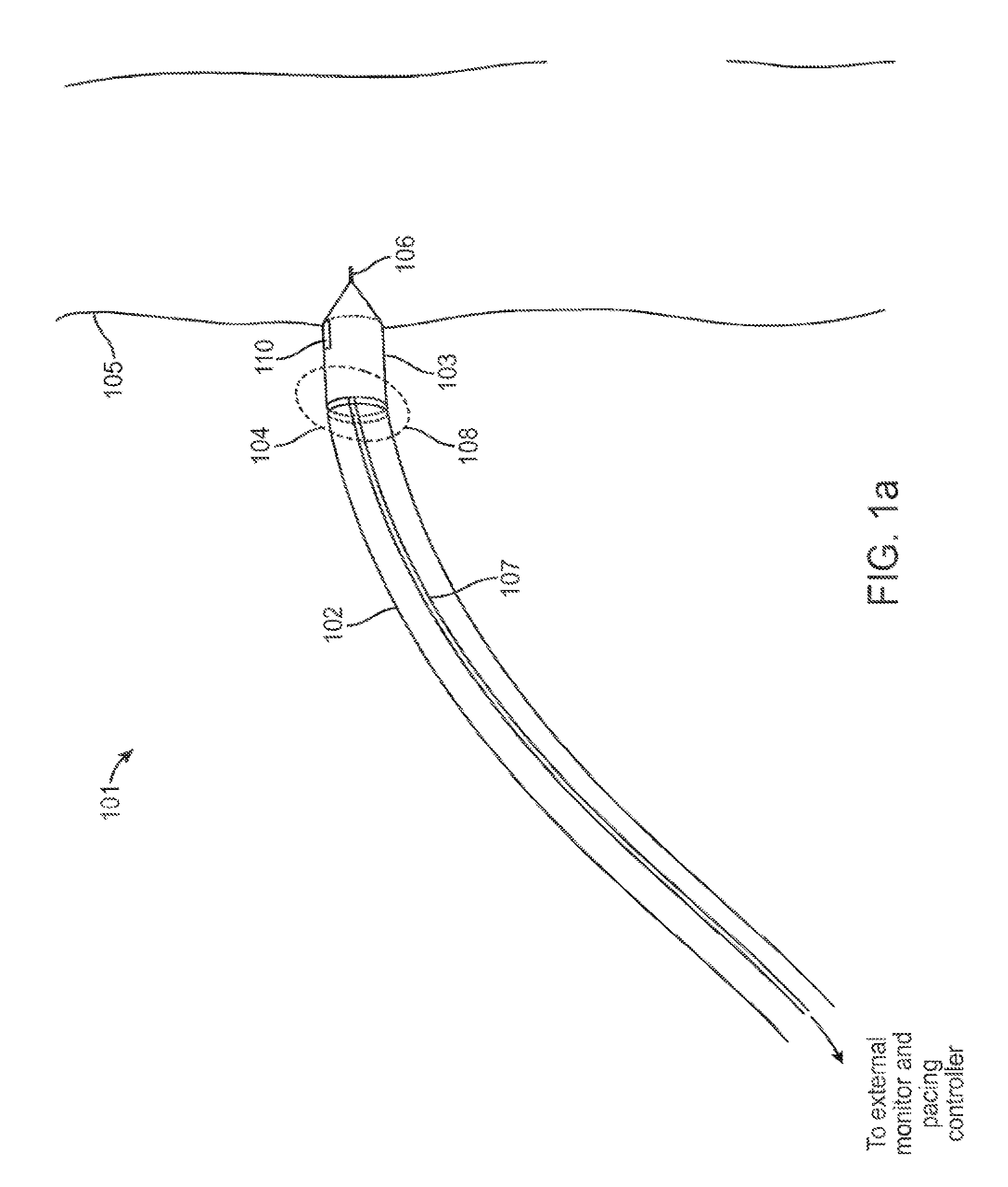 Temporary electrode connection for wireless pacing systems