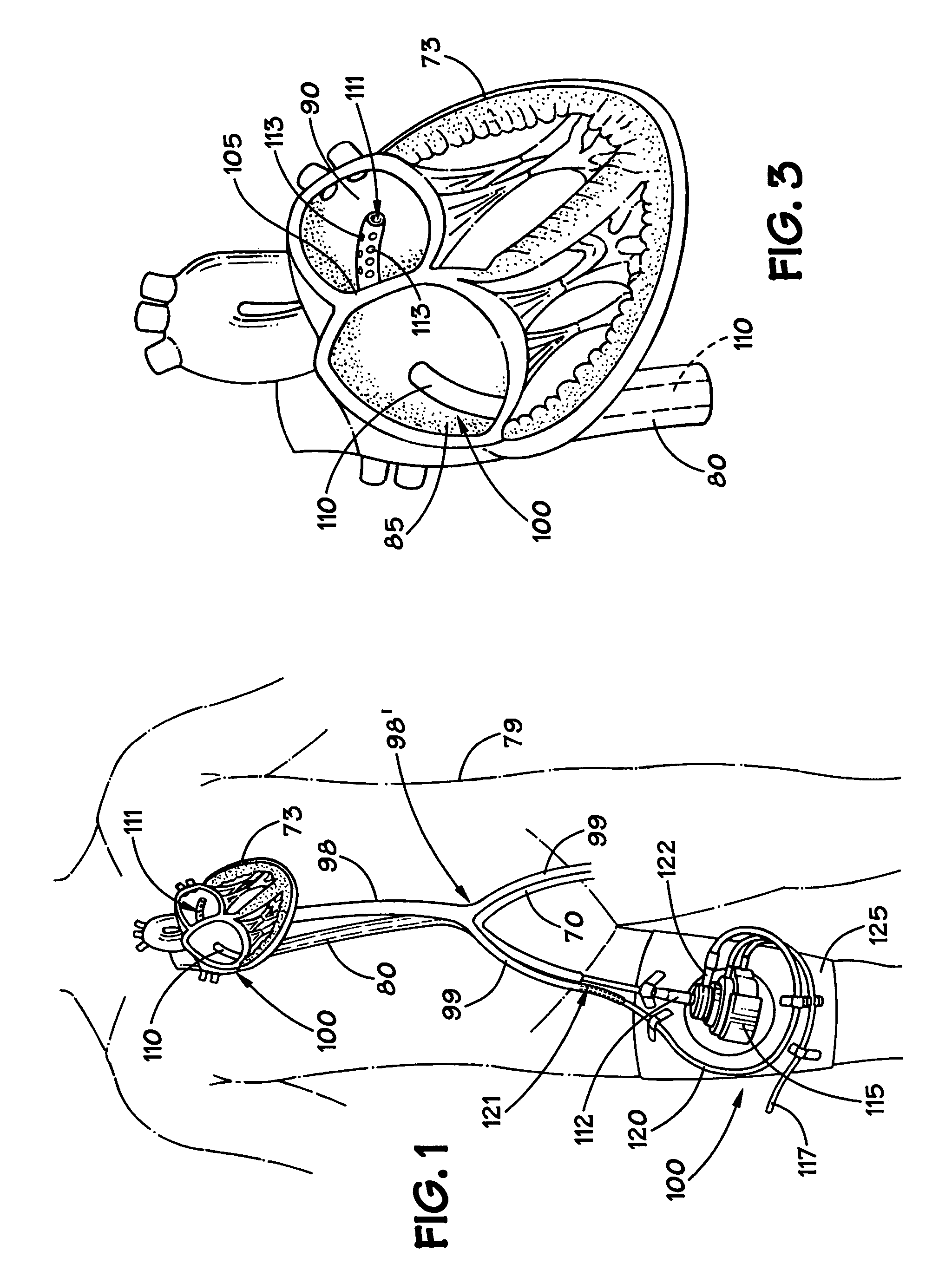Method and apparatus for implanting an aortic valve prosthesis