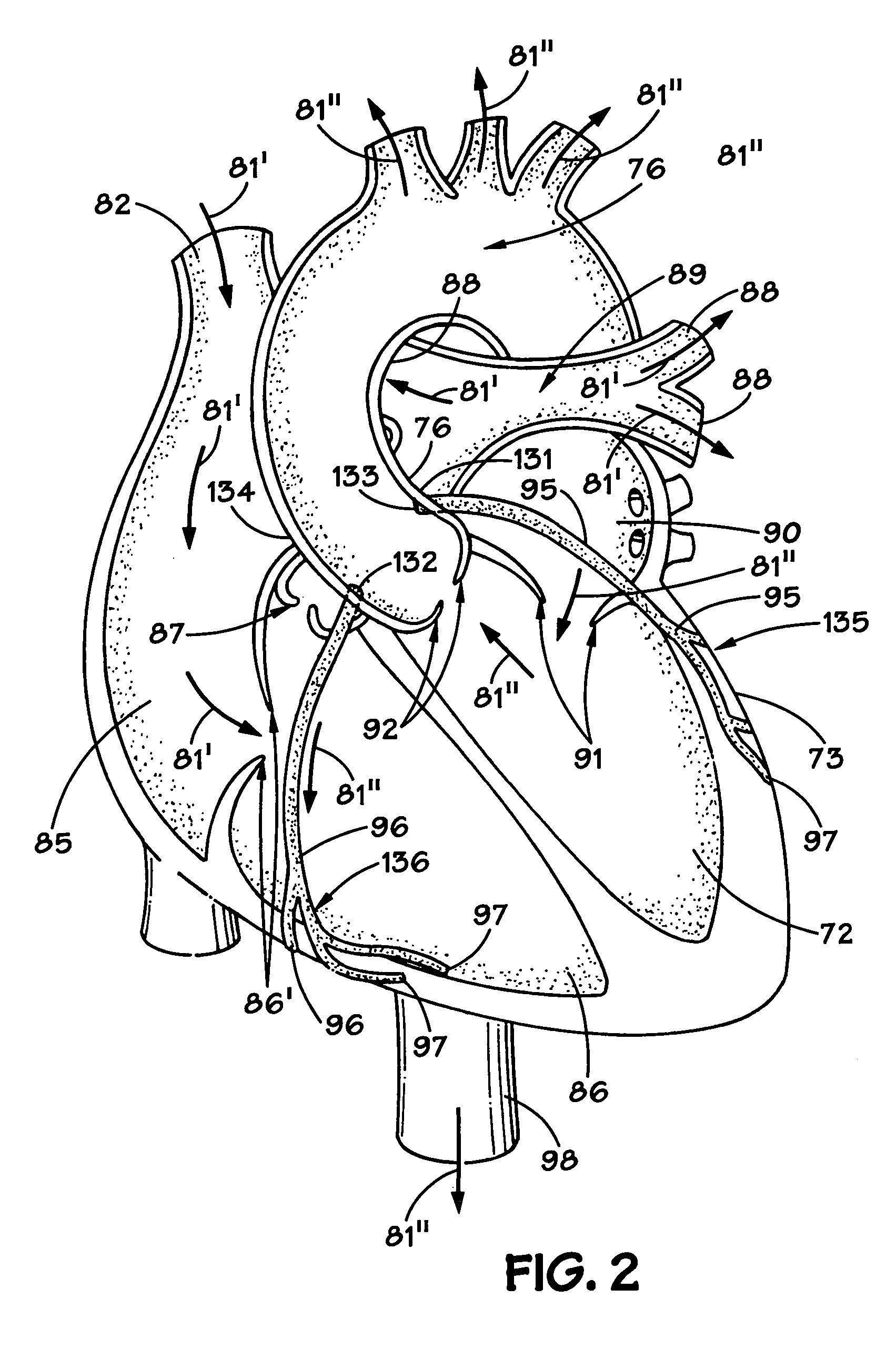 Method and apparatus for implanting an aortic valve prosthesis