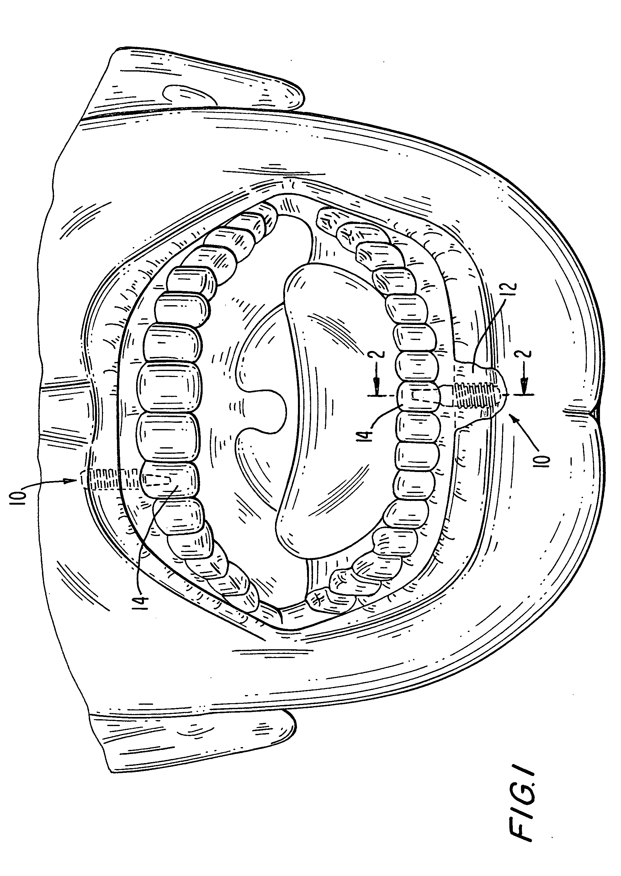 Aesthetic dental implant fixture and abutment system