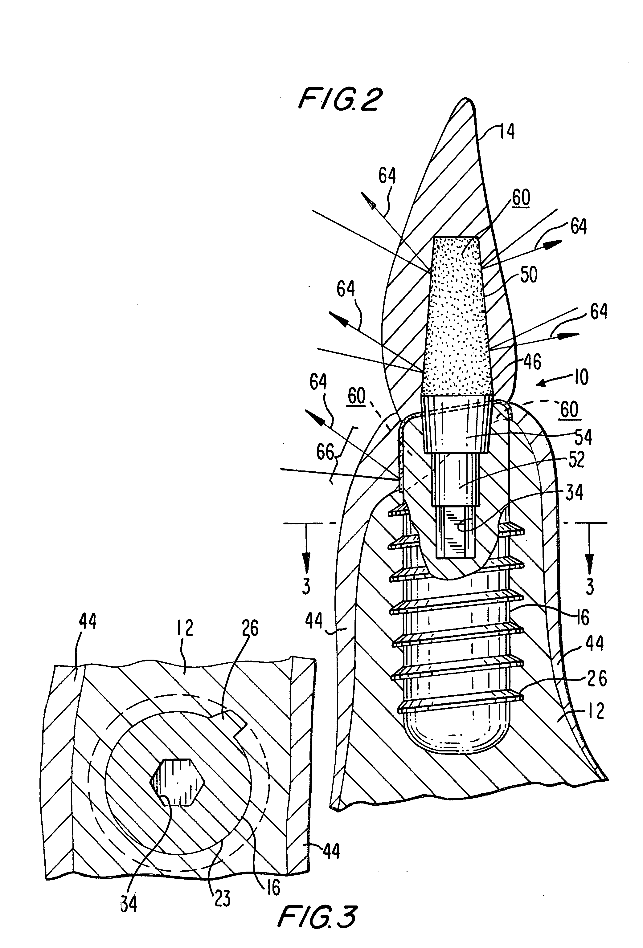 Aesthetic dental implant fixture and abutment system