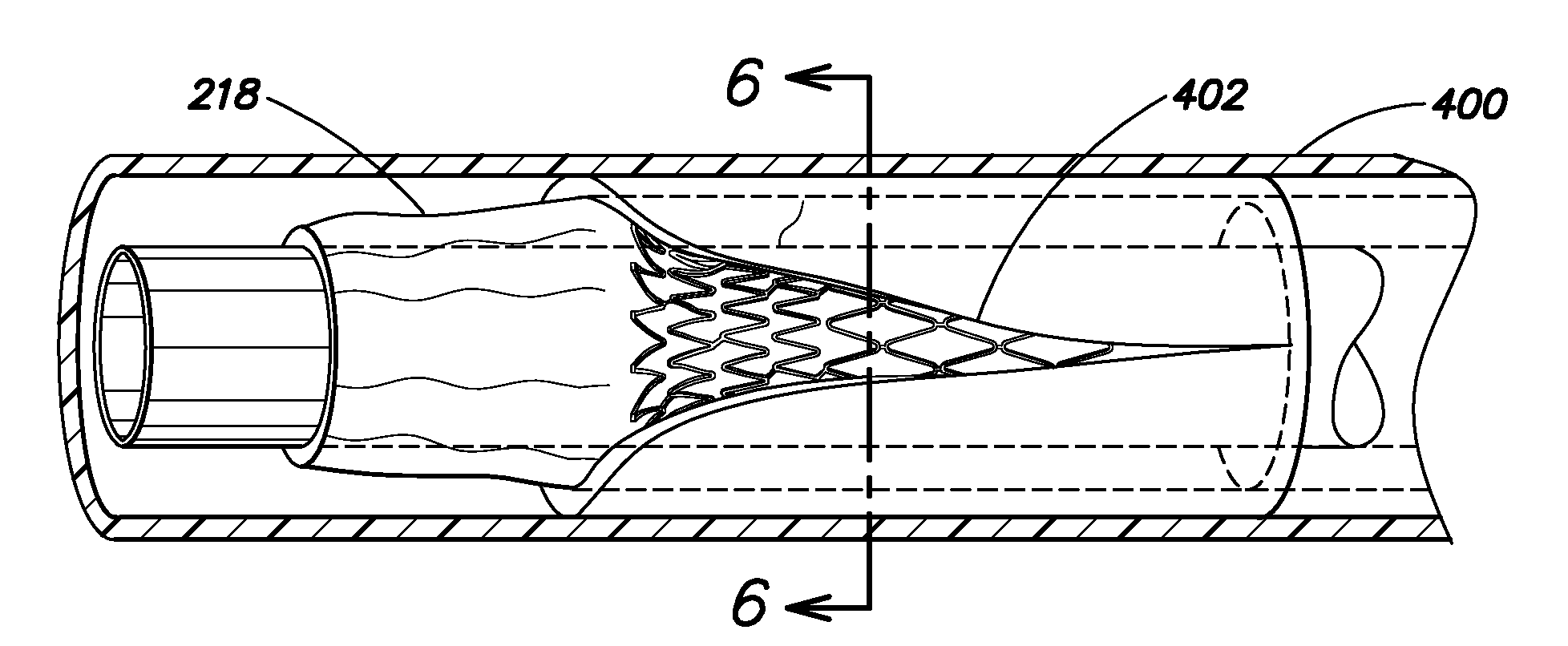 Delivery System With Profiled Sheath Having Balloon-Oriented Position