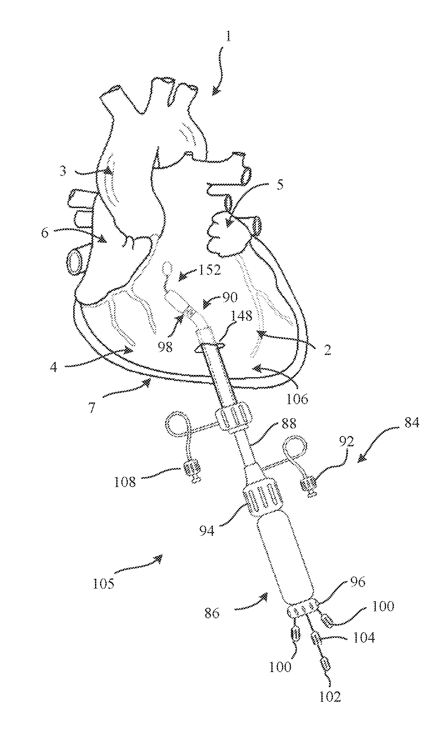 Epicardial Heart Rhythm Management Devices, Systems and Methods