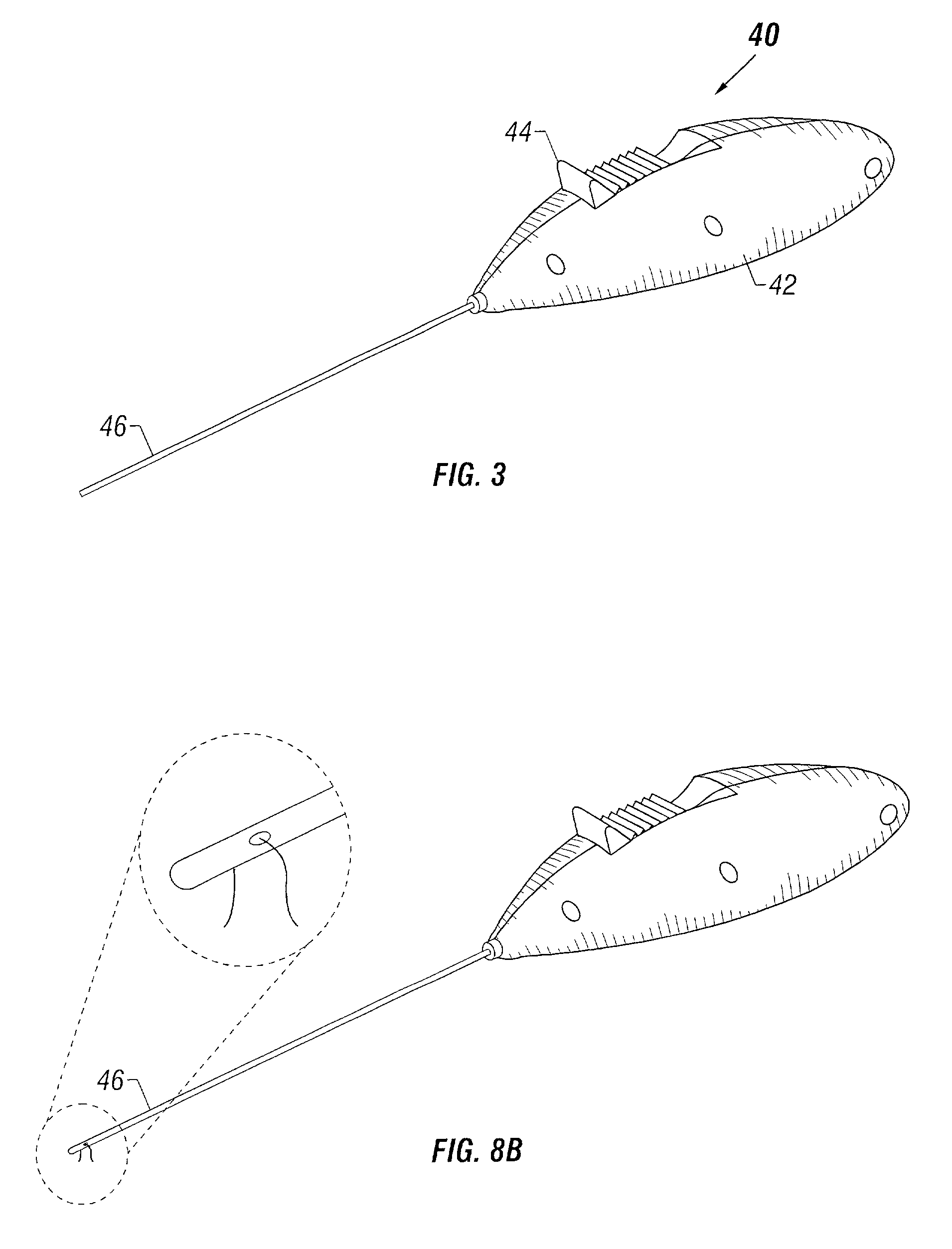 Method and apparatus for correction for gynecological pathologies including treatment of female cystocele