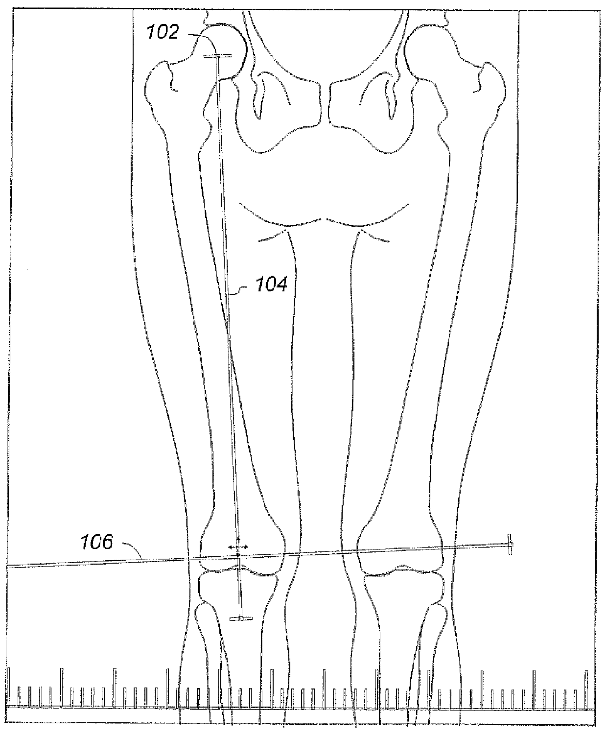 Bony balancing apparatus and method for total knee replacement