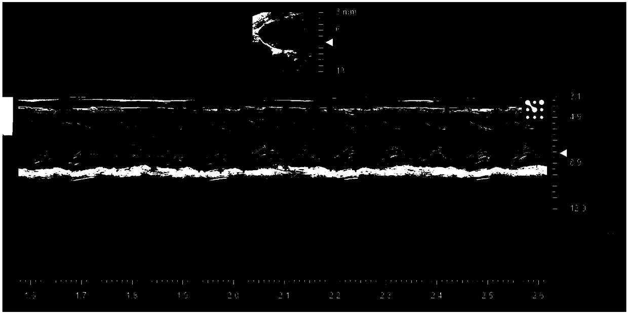 Drug use of 5-bromo-2-(alpha-hydroxypentyl) sodium benzoate in treatment of cardiac hypertrophy and heart failure