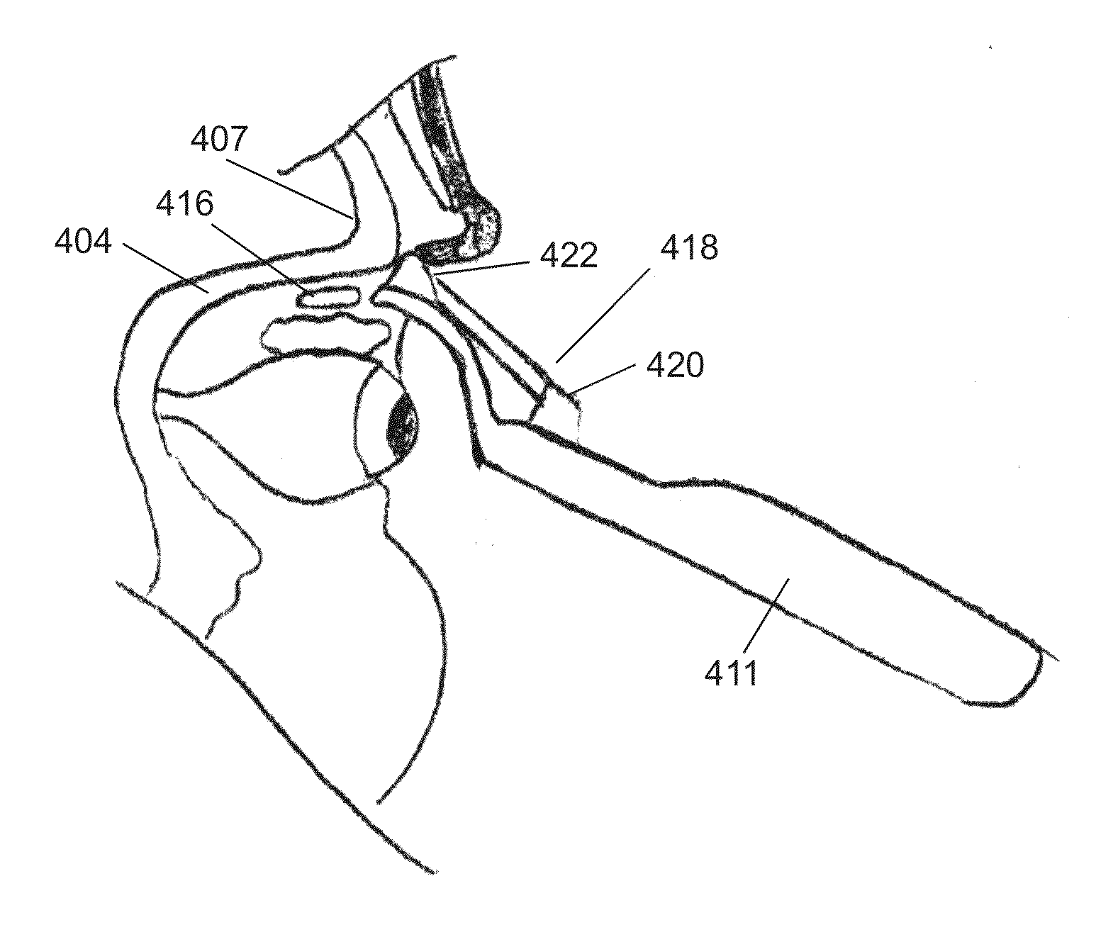 Implant delivery devices, systems, and methods