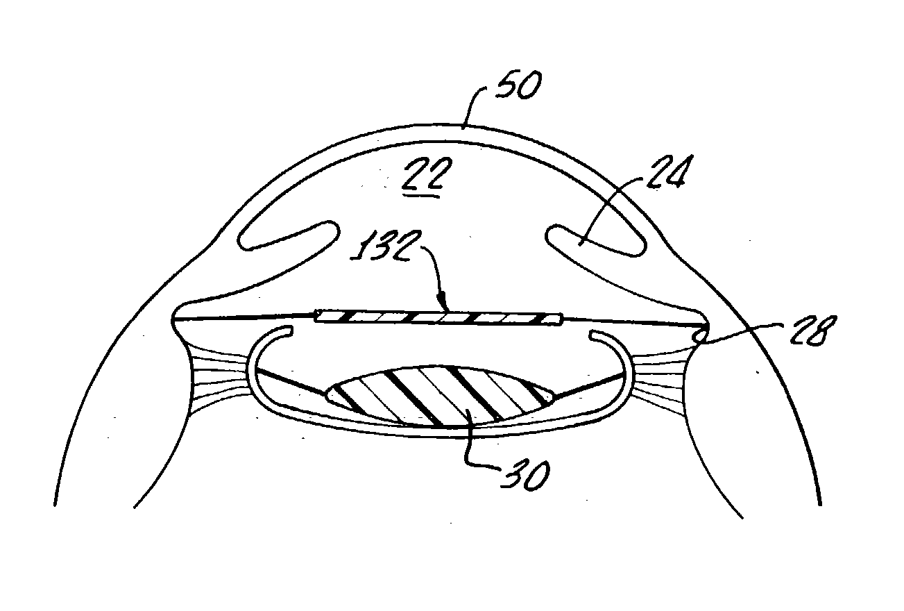 Primary and supplemental intraocular lens