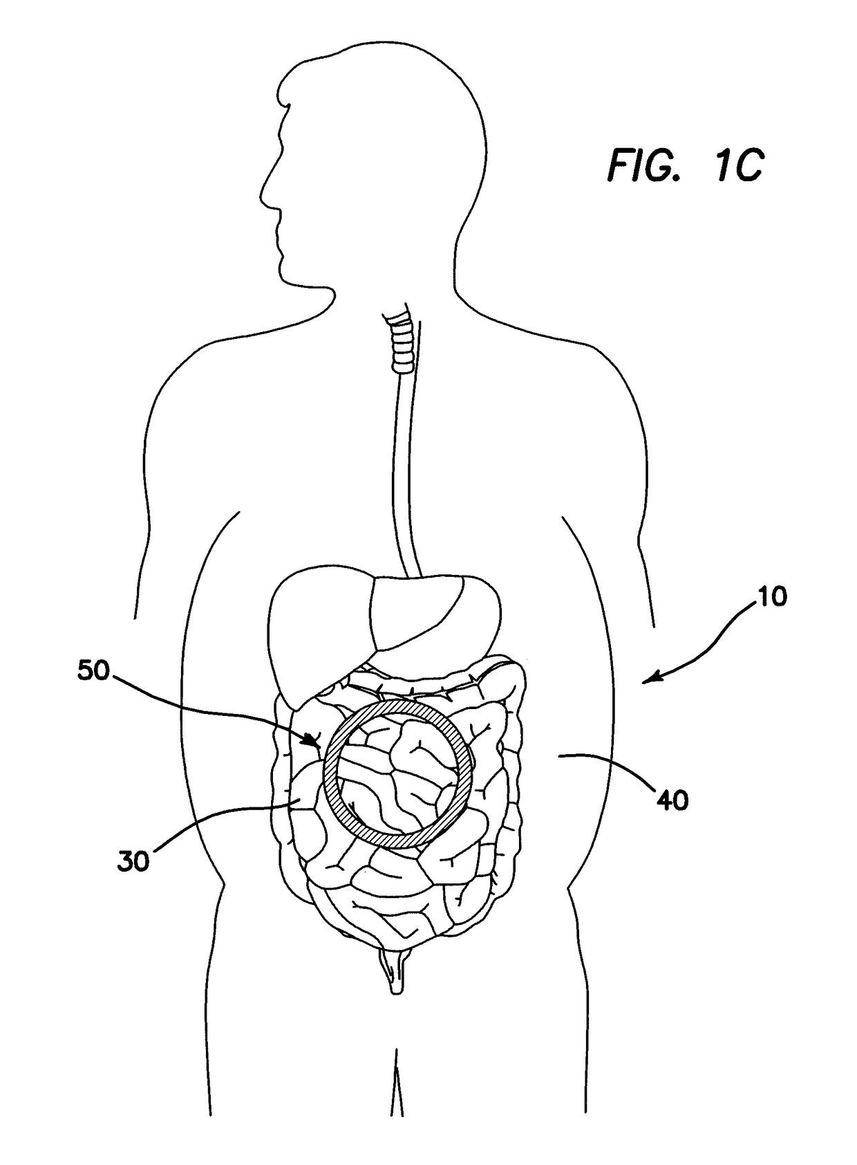 Surgical access device comprising internal retractor
