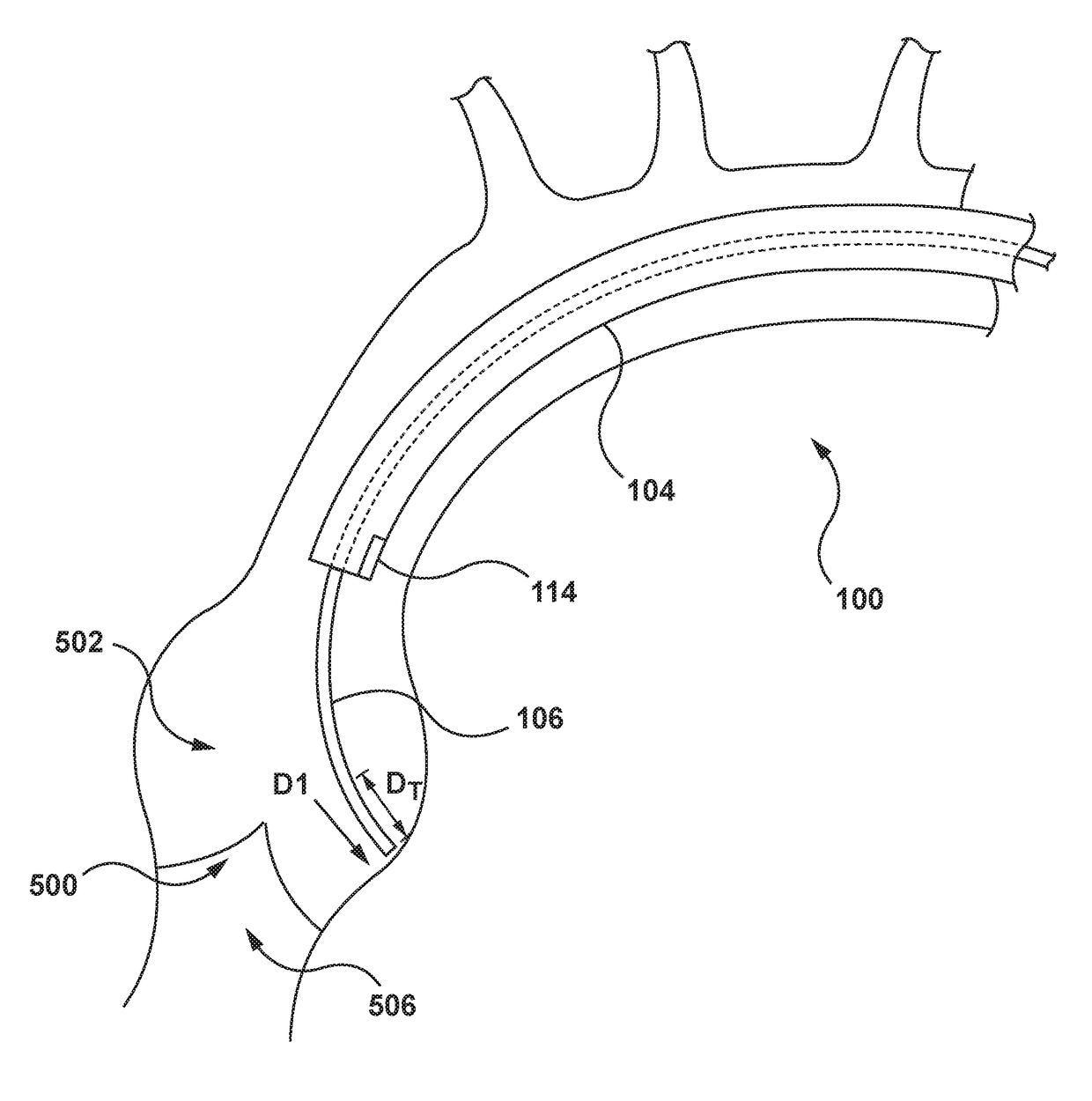 System and method for crossing a native heart valve with a guidewire