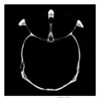 Computed tomography (CT) image and magnetic resonance (MR) image fusion method