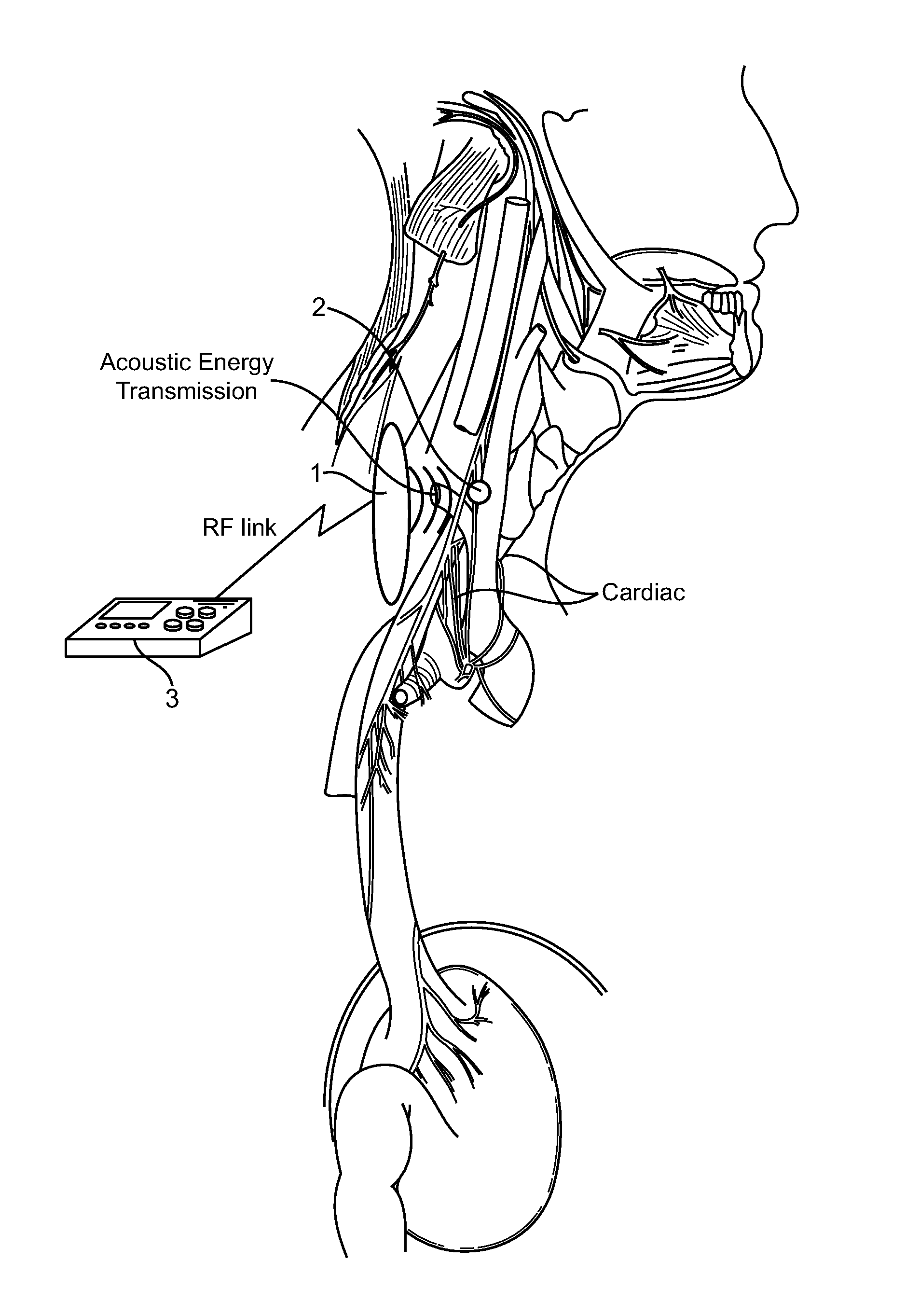 Systems and methods for implantable leadless nerve stimulation