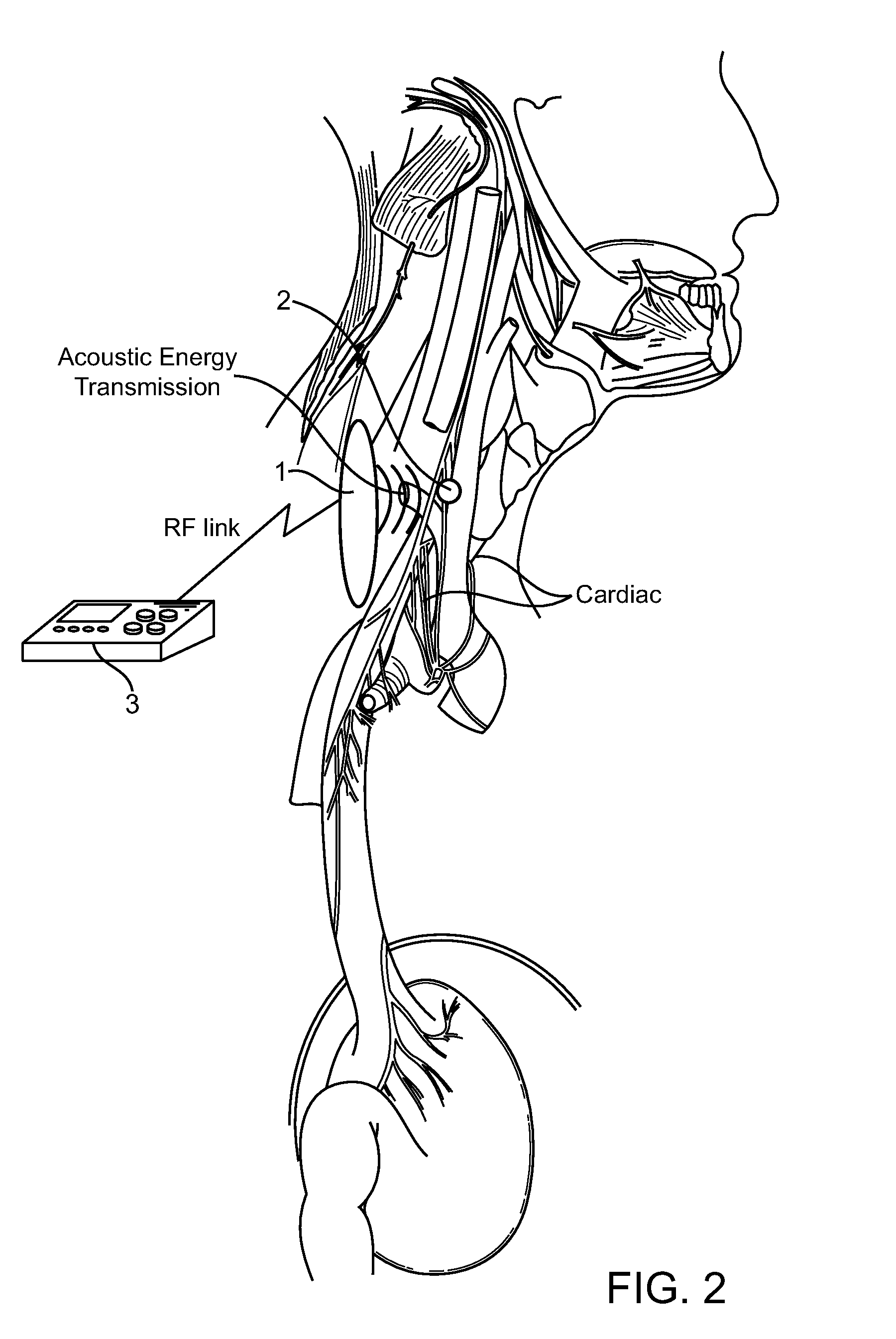 Systems and methods for implantable leadless nerve stimulation