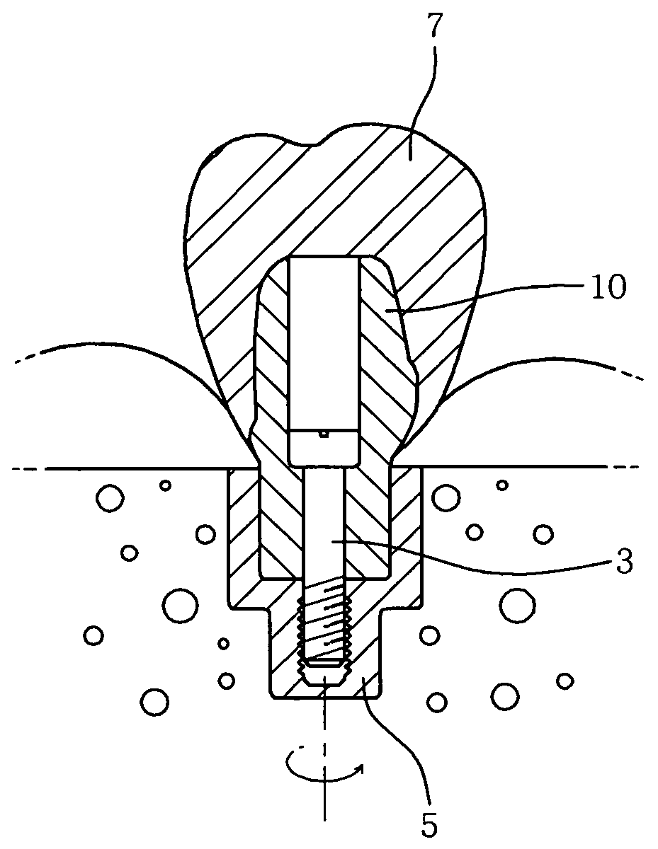 Method for manufacturing the one body abutment of implant