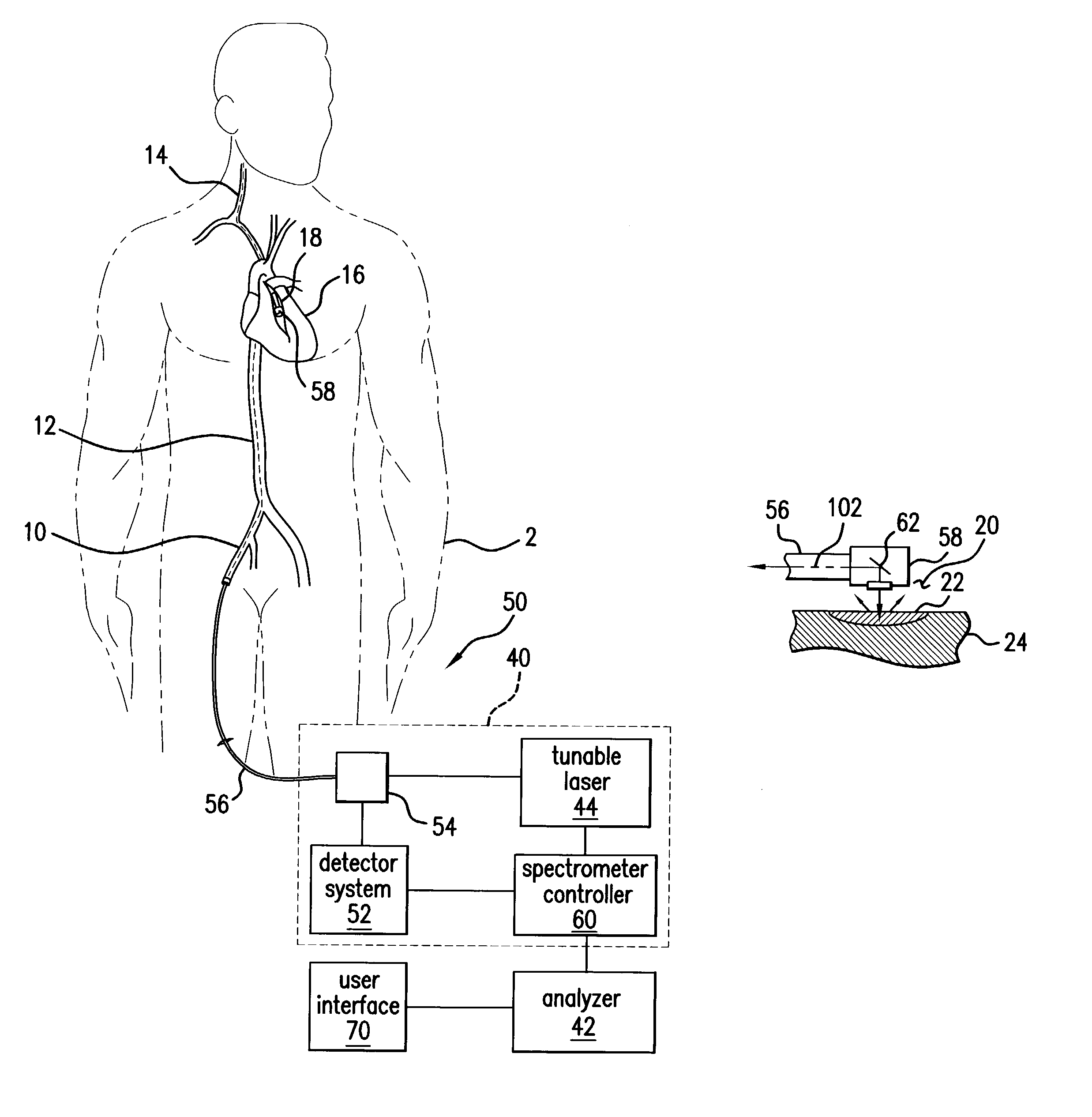 Spectroscopic unwanted signal filters for discrimination of vulnerable plaque and method therefor