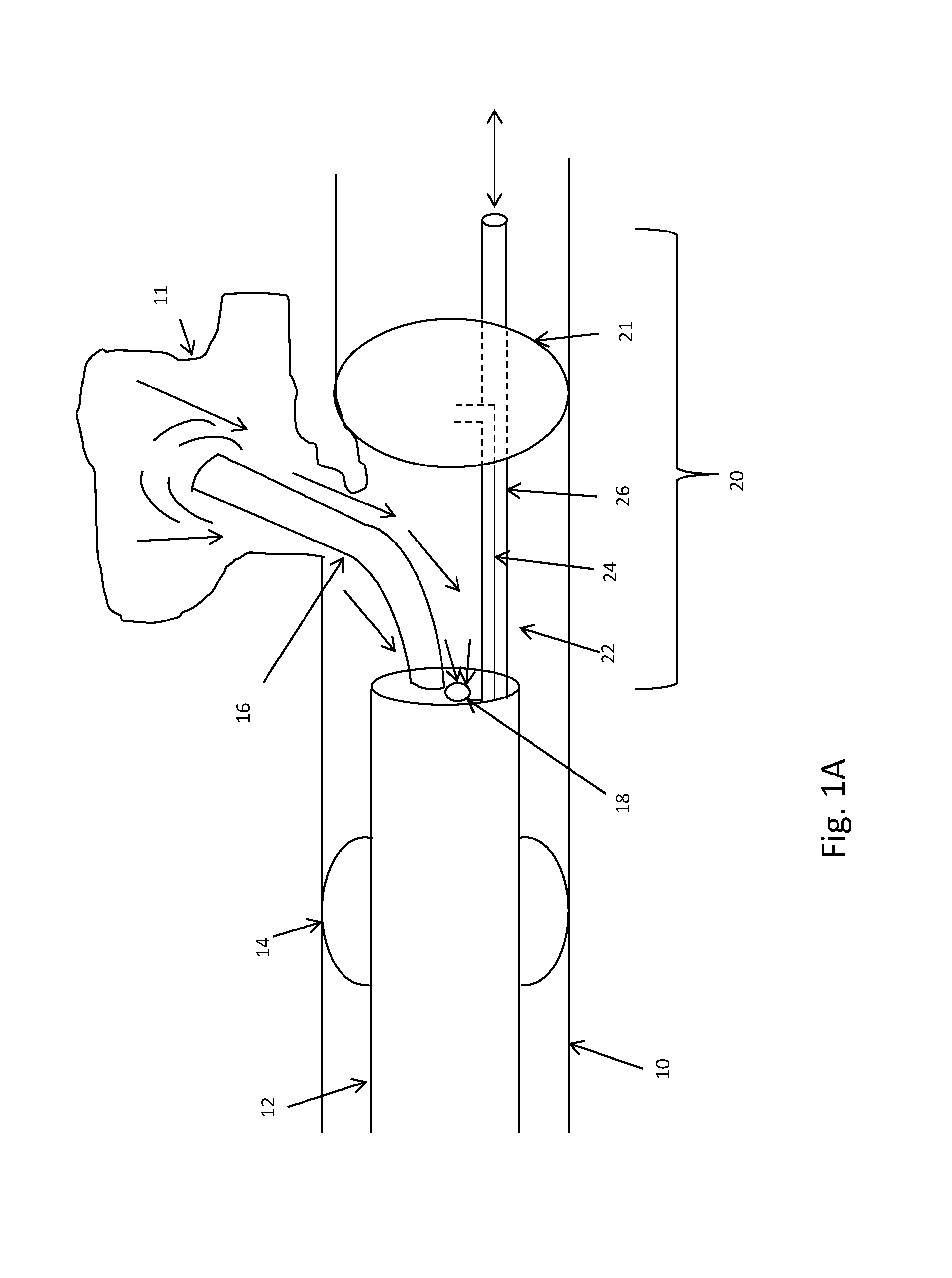 System and method for treating COPD and emphysema