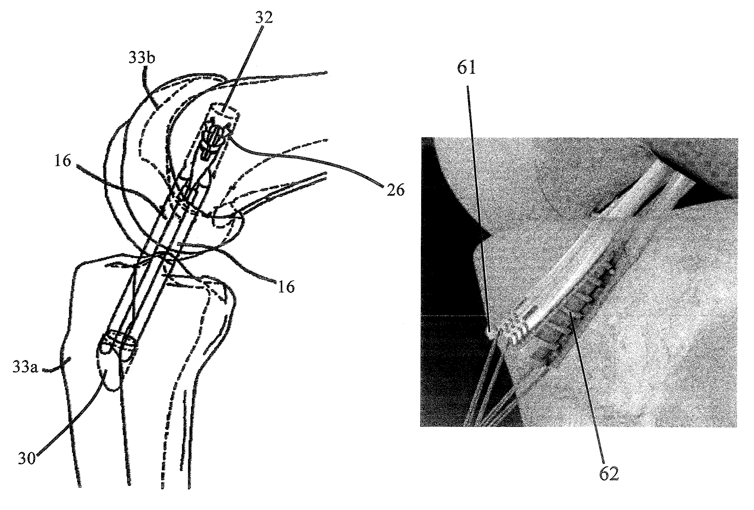 Method for surgically repairing a damaged ligament