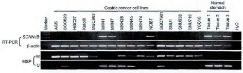 A cancer diagnosis chip and its kit