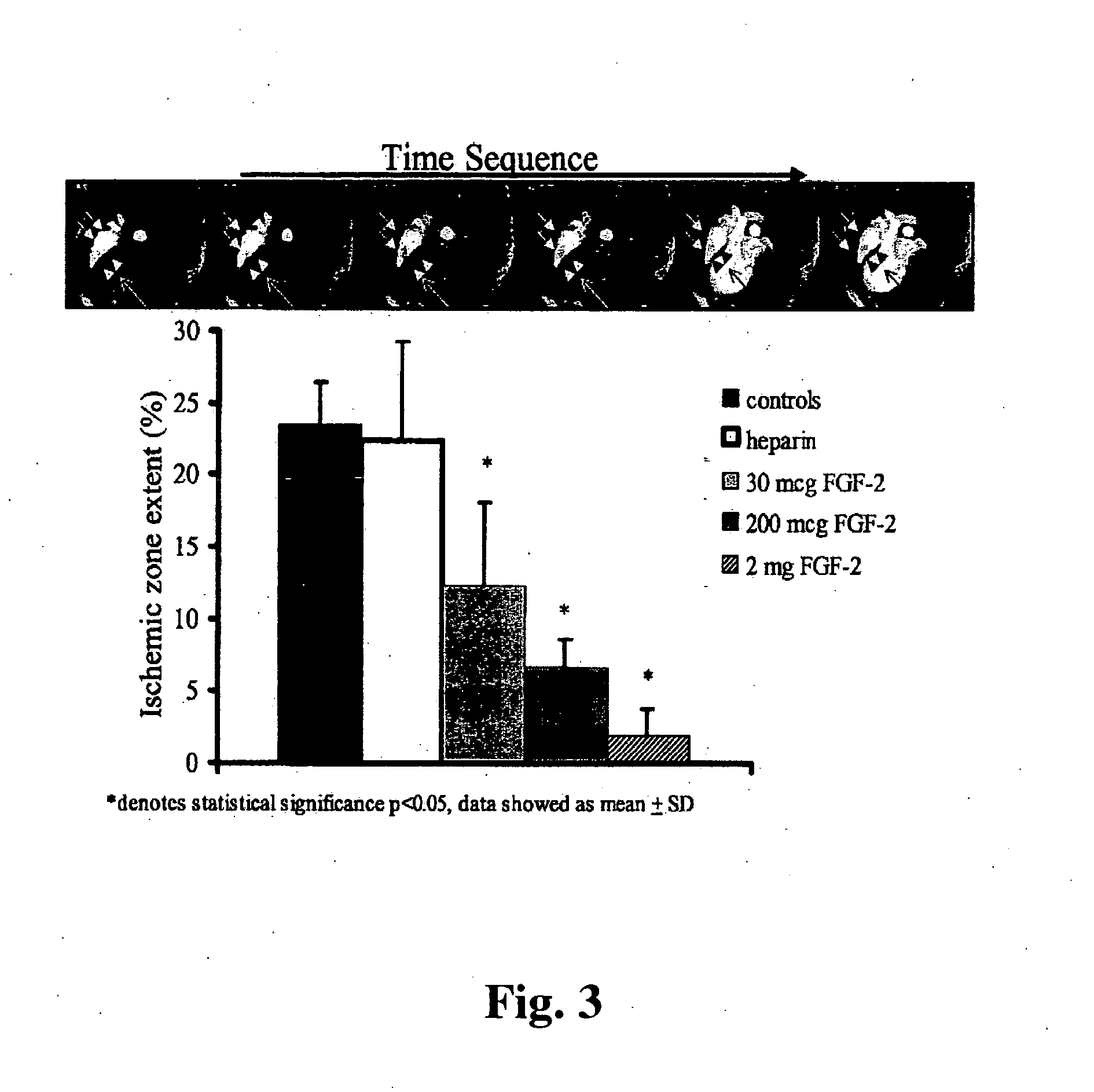 Combination growth factor therapy and cell therapy for treatment of acute and chronic heart disease