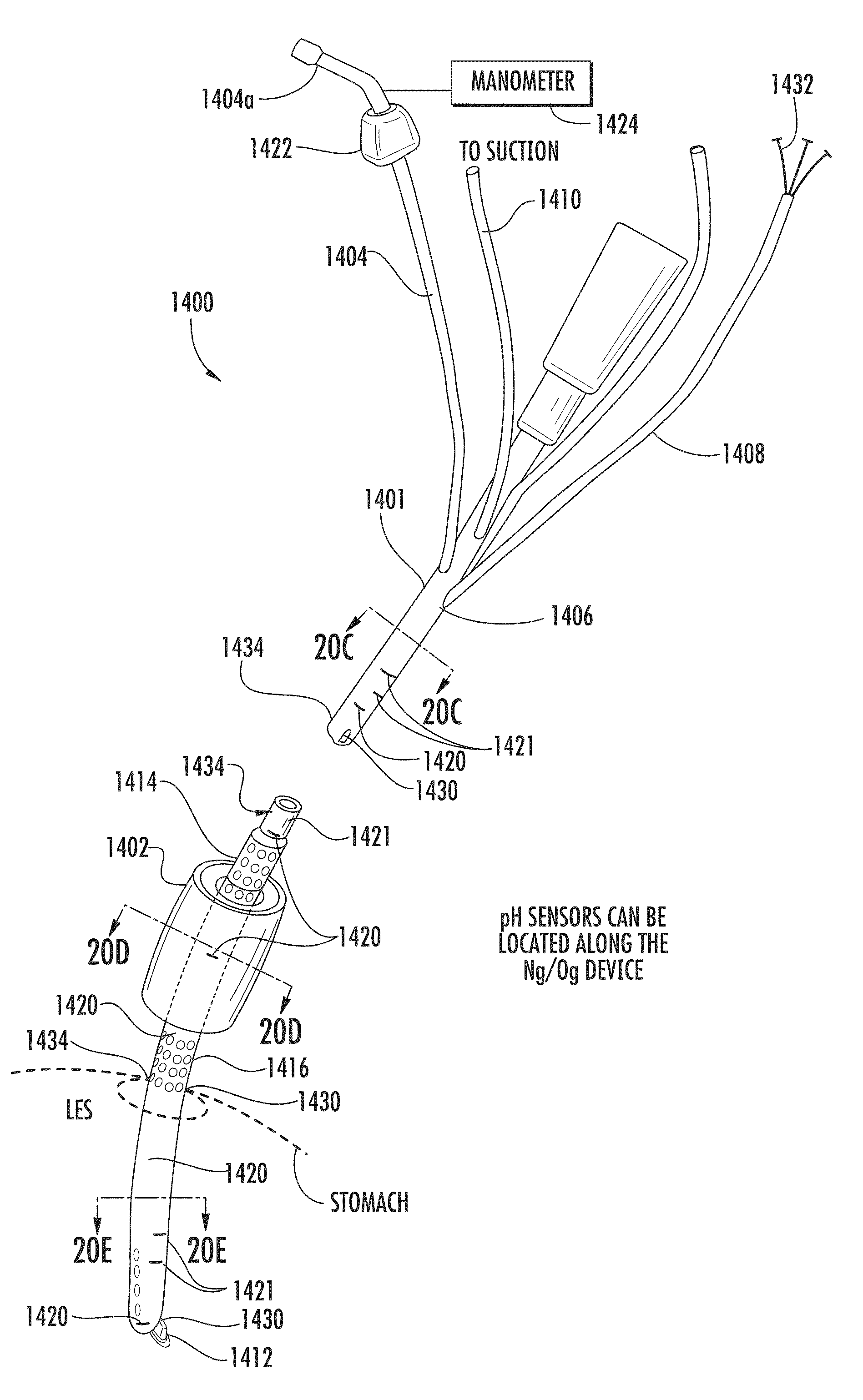 Urinary catheter system for diagnosing a physiological abnormality such as stress urinary incontinence