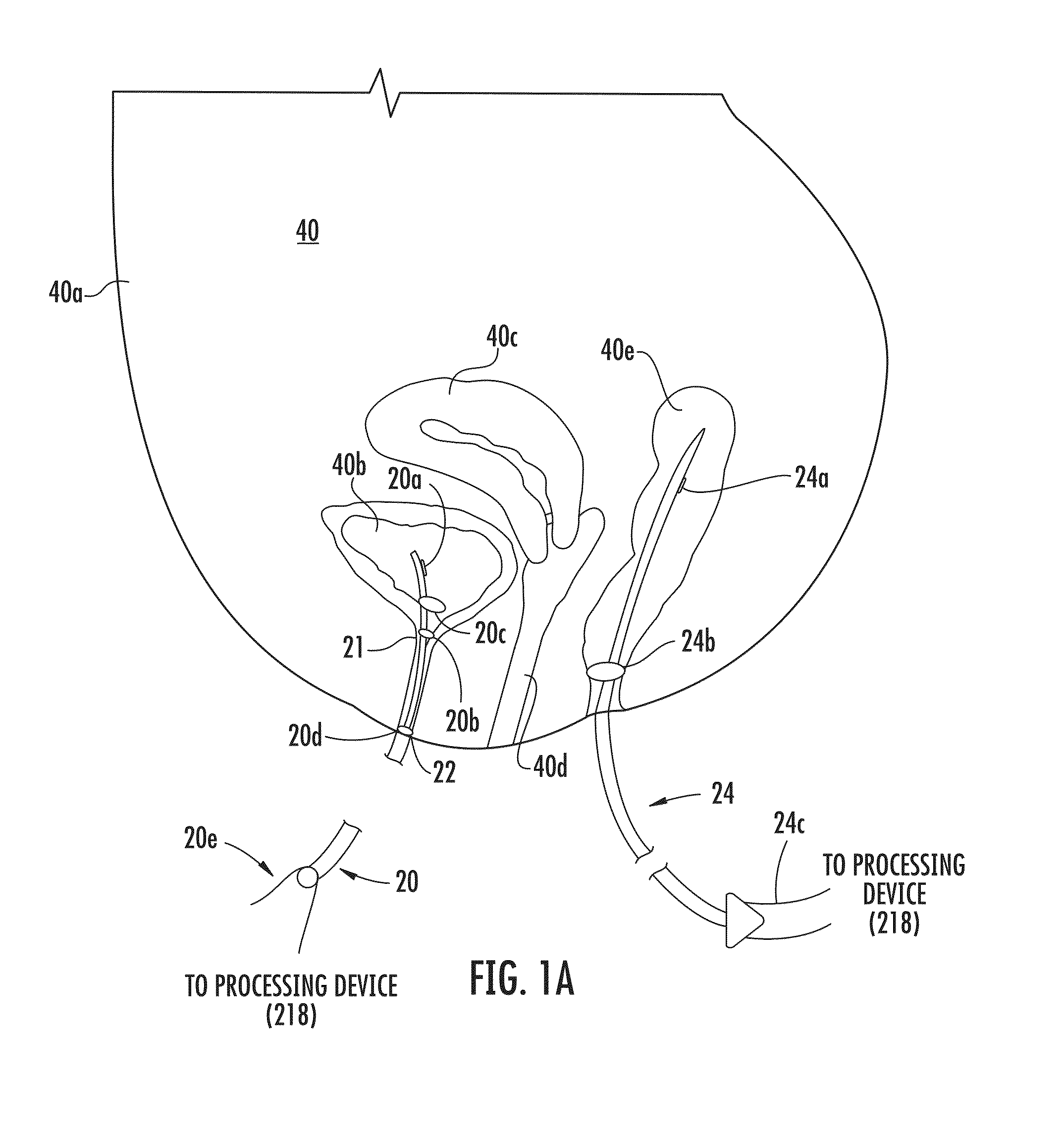 Urinary catheter system for diagnosing a physiological abnormality such as stress urinary incontinence