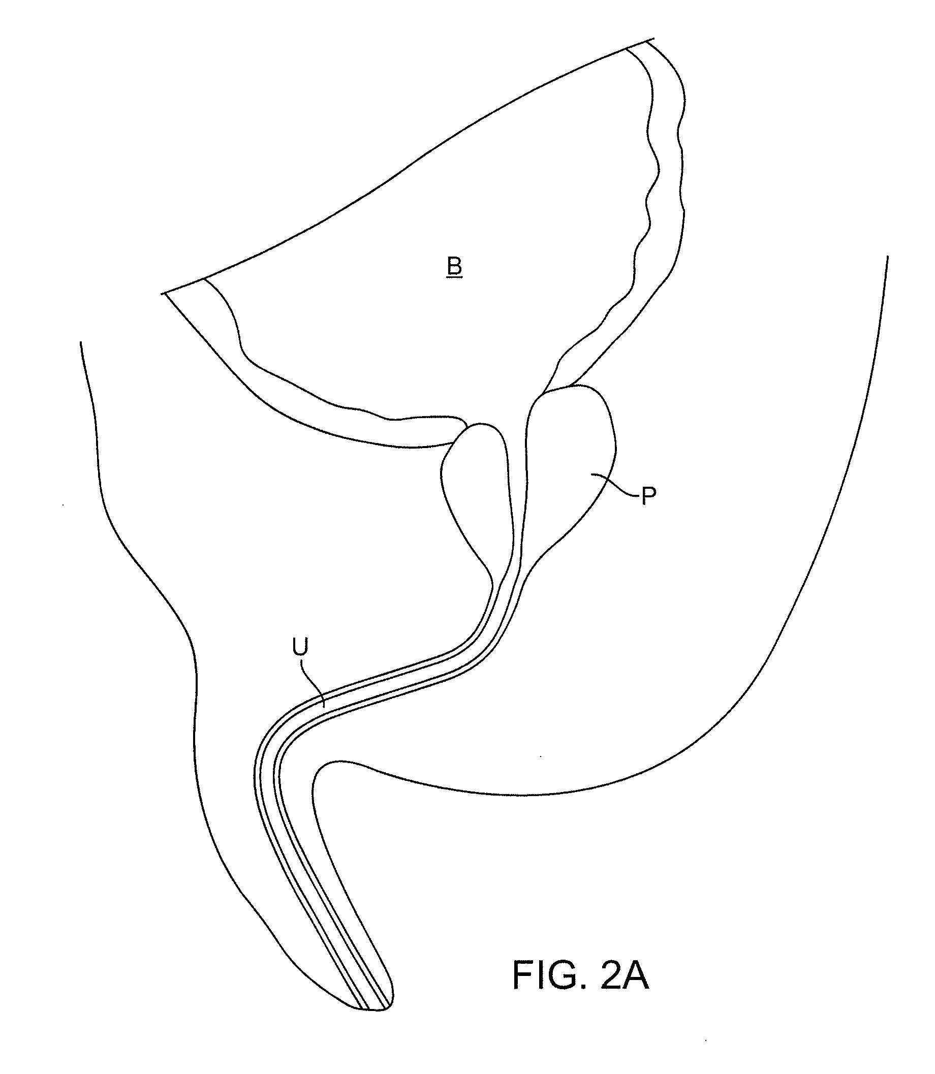 Multi fluid tissue resection methods and devices