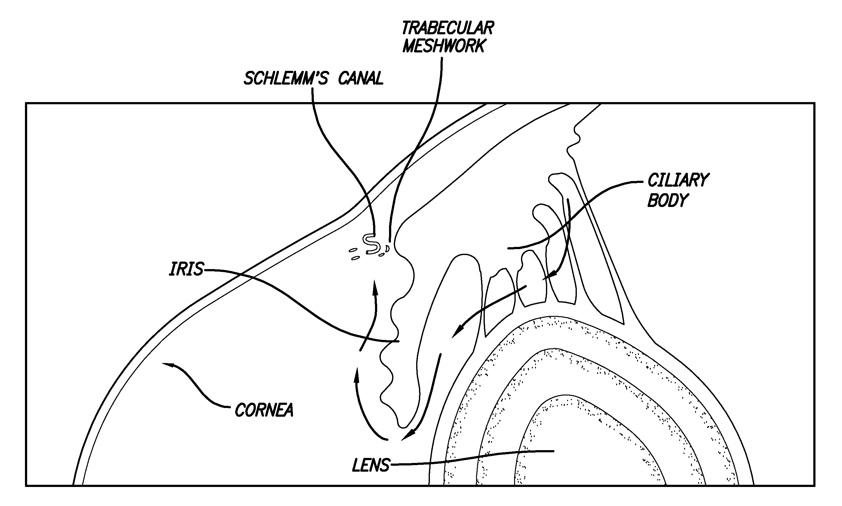 Ultrasonic treatment of glaucoma