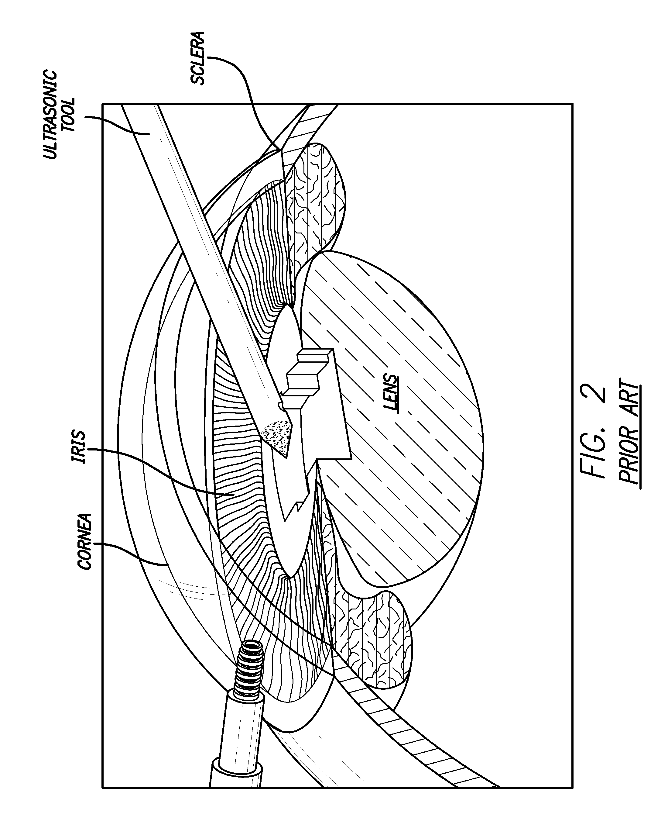 Ultrasonic treatment of glaucoma