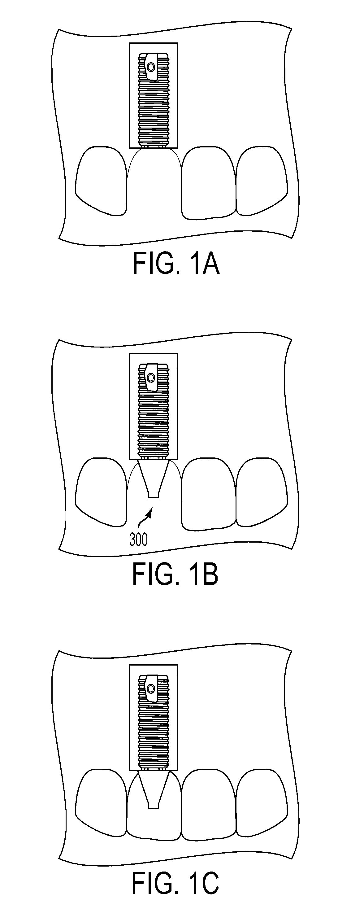 Guided dental implantation system and associated device and method