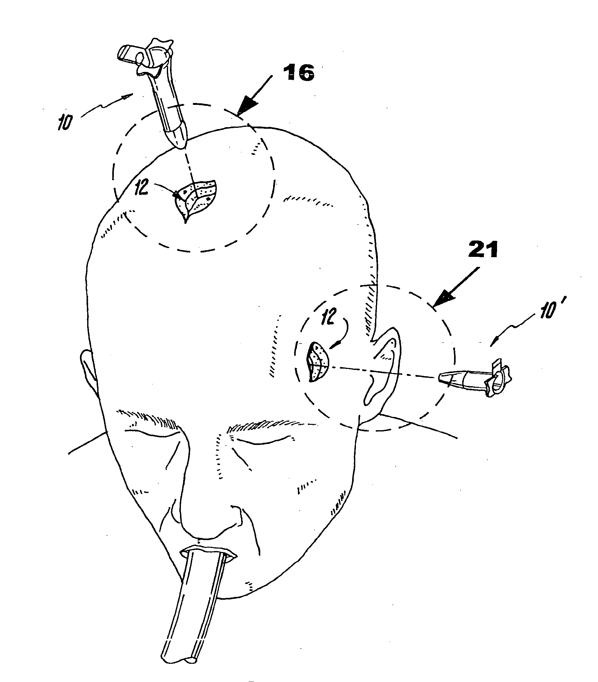 Surgical Access Methods For Use With Delicate Tissues